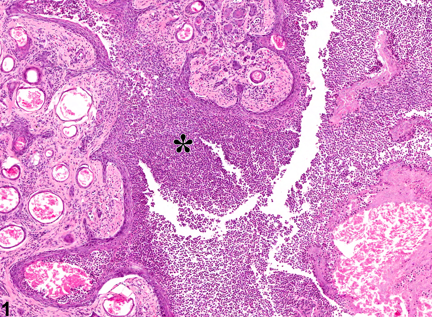 Image of inflammation in the preputial gland from a male F344/N rat in a chronic study