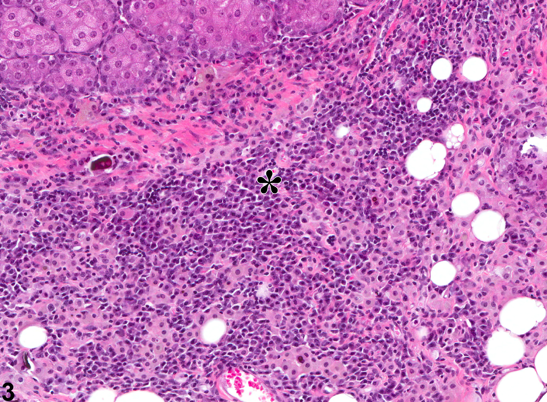 Image of inflammation in the preputial gland from a male B6C3F1 mouse in a chronic study