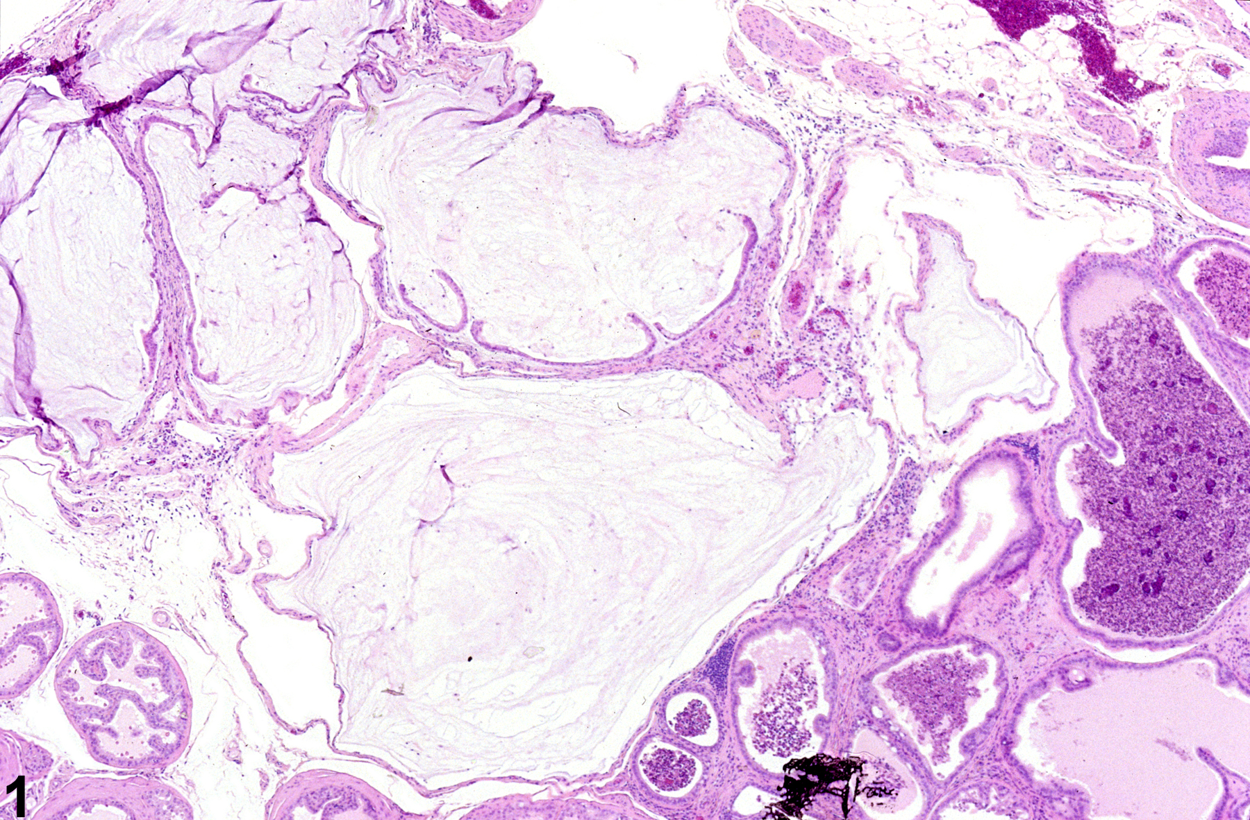 Image of acinar mucinous cyst in the prostate from a male F344/N rat in a chronic study
