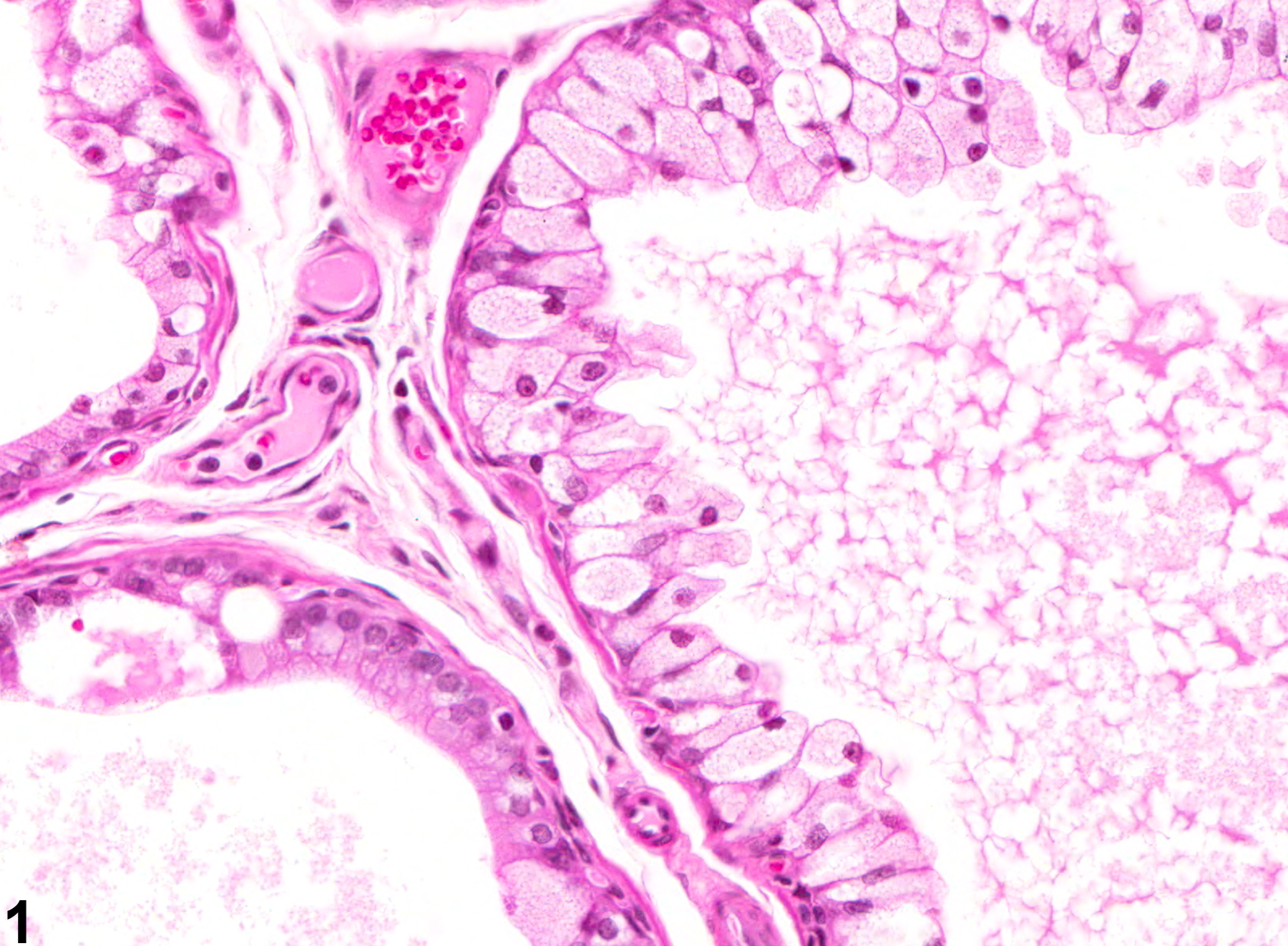 Image of epithelial degeneration in the prostate from a male F344/N rat in a chronic study