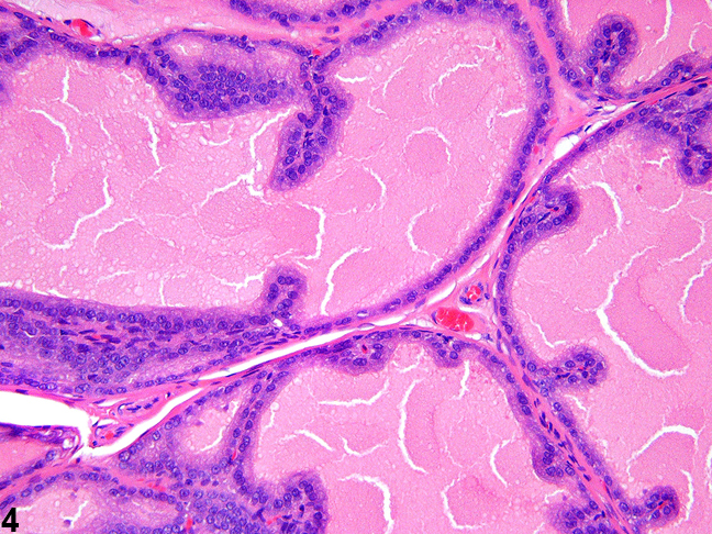 Image of cuboidal epithelial lining of ascini with occasional papillary infoldings in the prostate