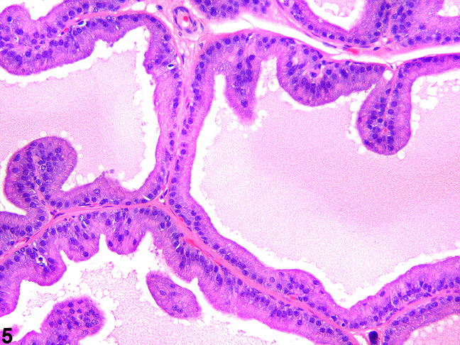 Image of tall columnar epithelial lining with occasional infoldings of the ascinar lining in the prostate