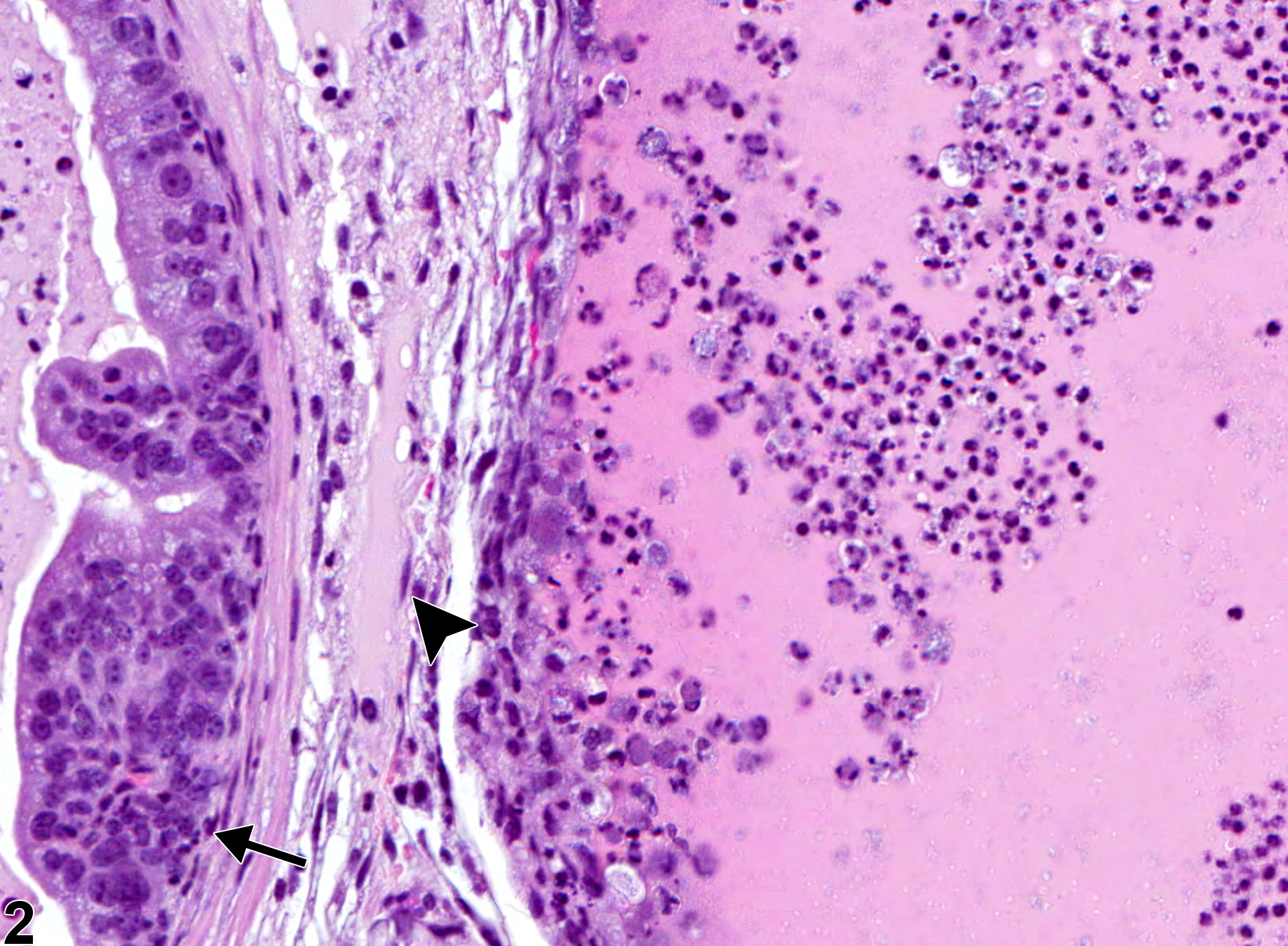 Image of inflammation in the seminal vesicle from a male B6C3F1 mouse in an chronic study