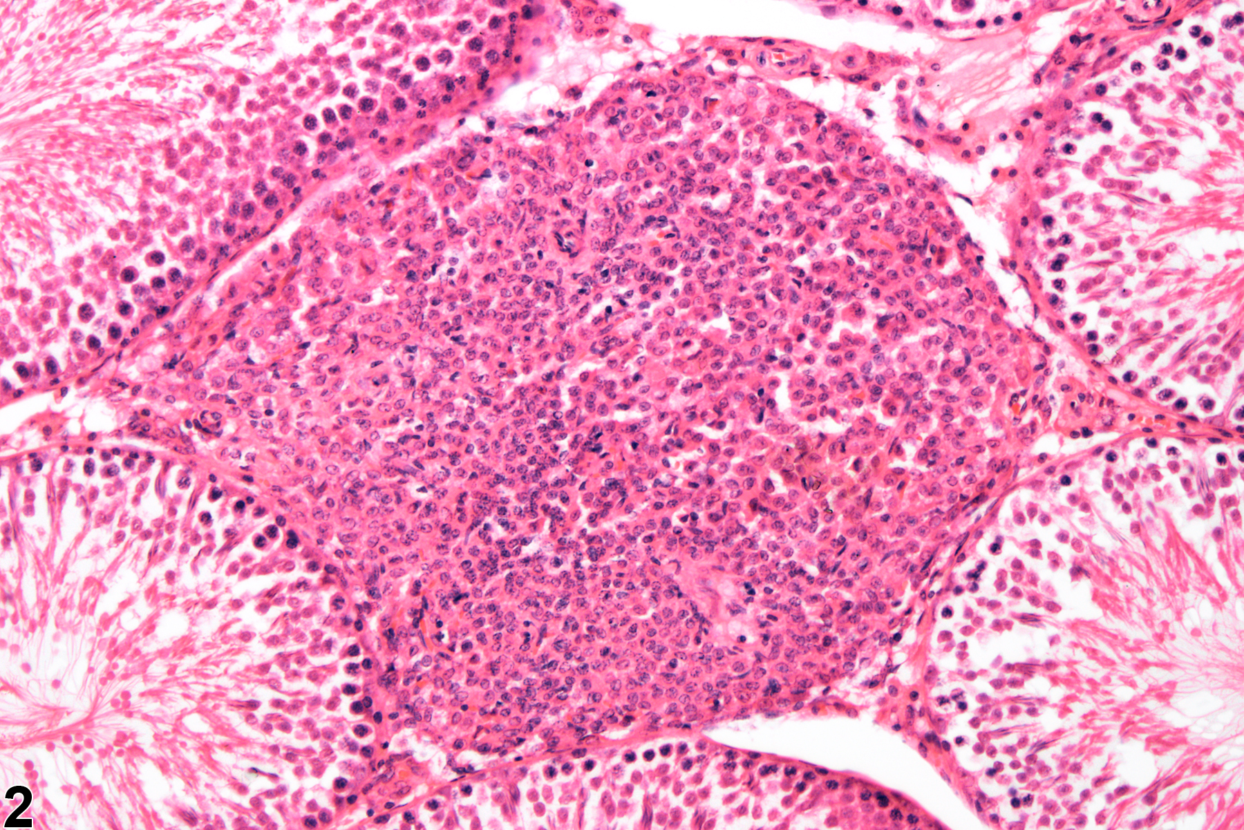 Image of interstitial cell hyperplasia in the testis from a male F344/N rat in a chronic study
