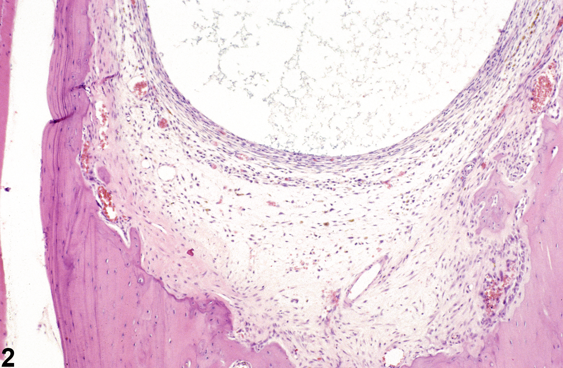 Image of cyst in the bone from a female B6C3F1/N mouse in a chronic study