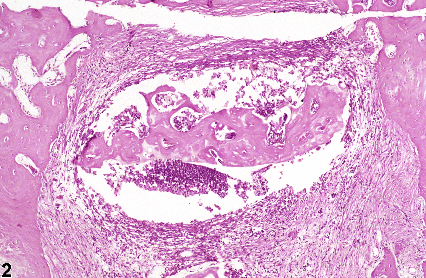 Image of inflammation in the bone from a male B6C3F1/N mouse in a chronic study