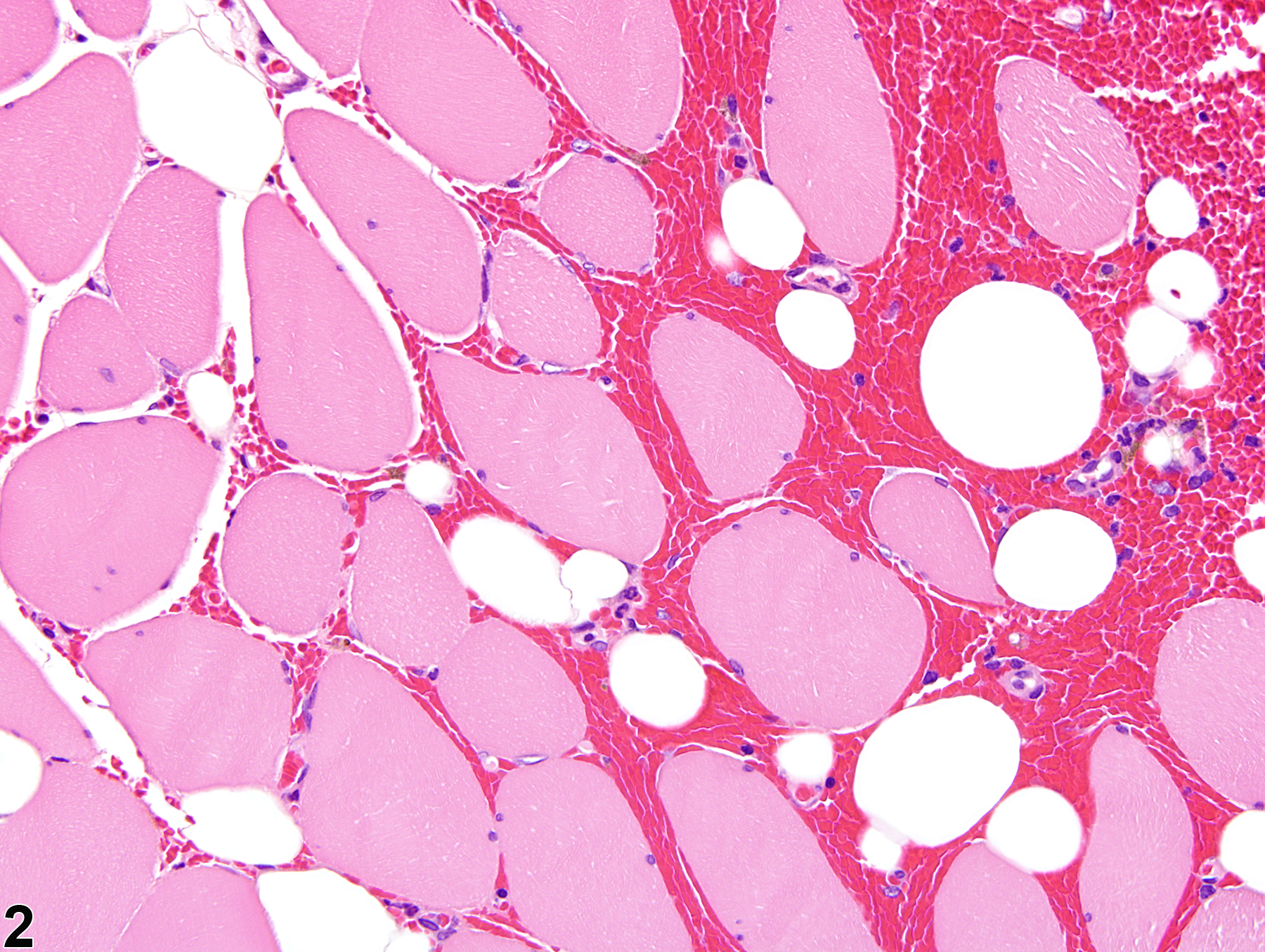Image of hemorrhage in the skeletal muscle from a male F344/N rat in a chronic study