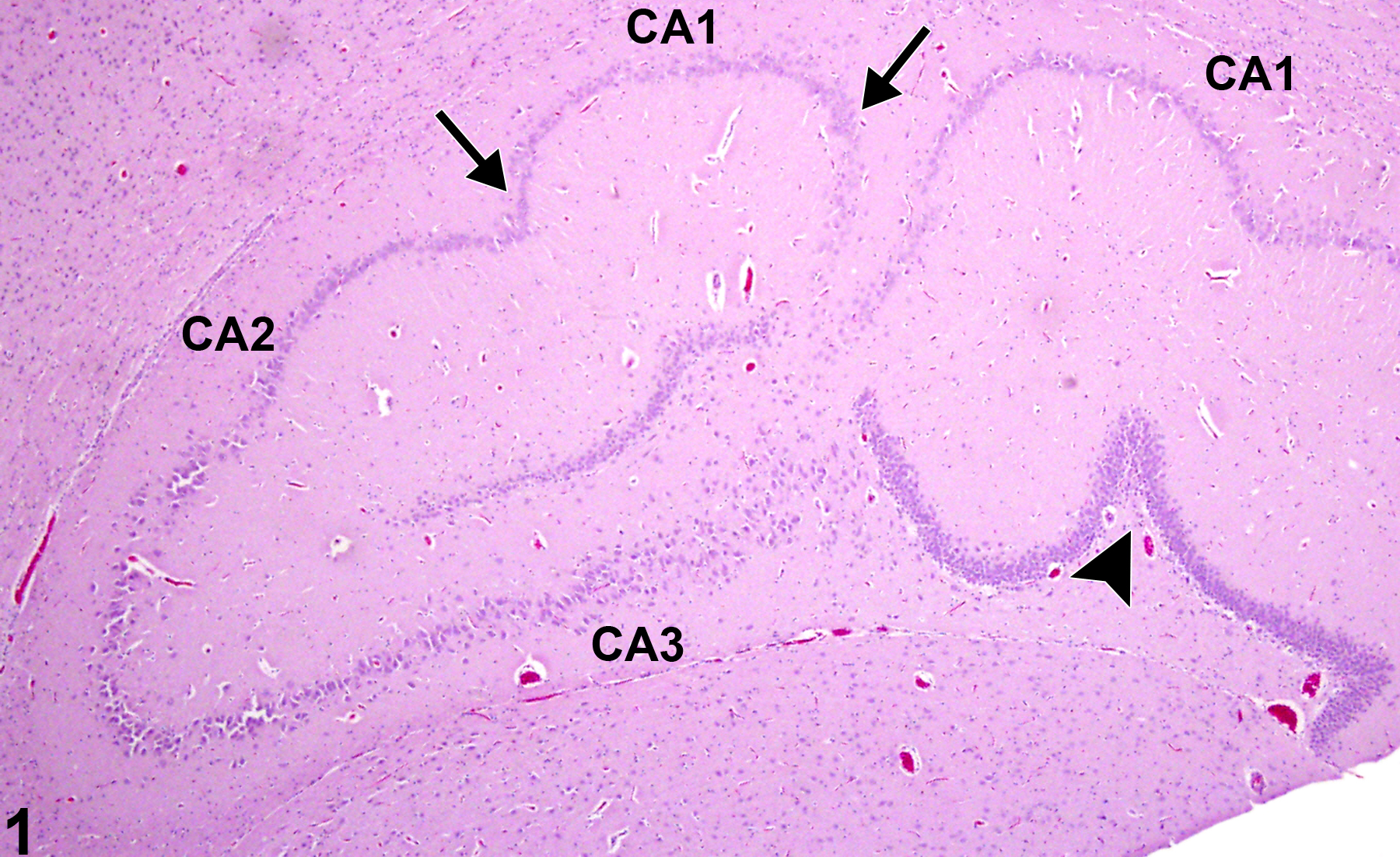 Image of dysplasia in the brain from a female F344/N rat in a 2 year study