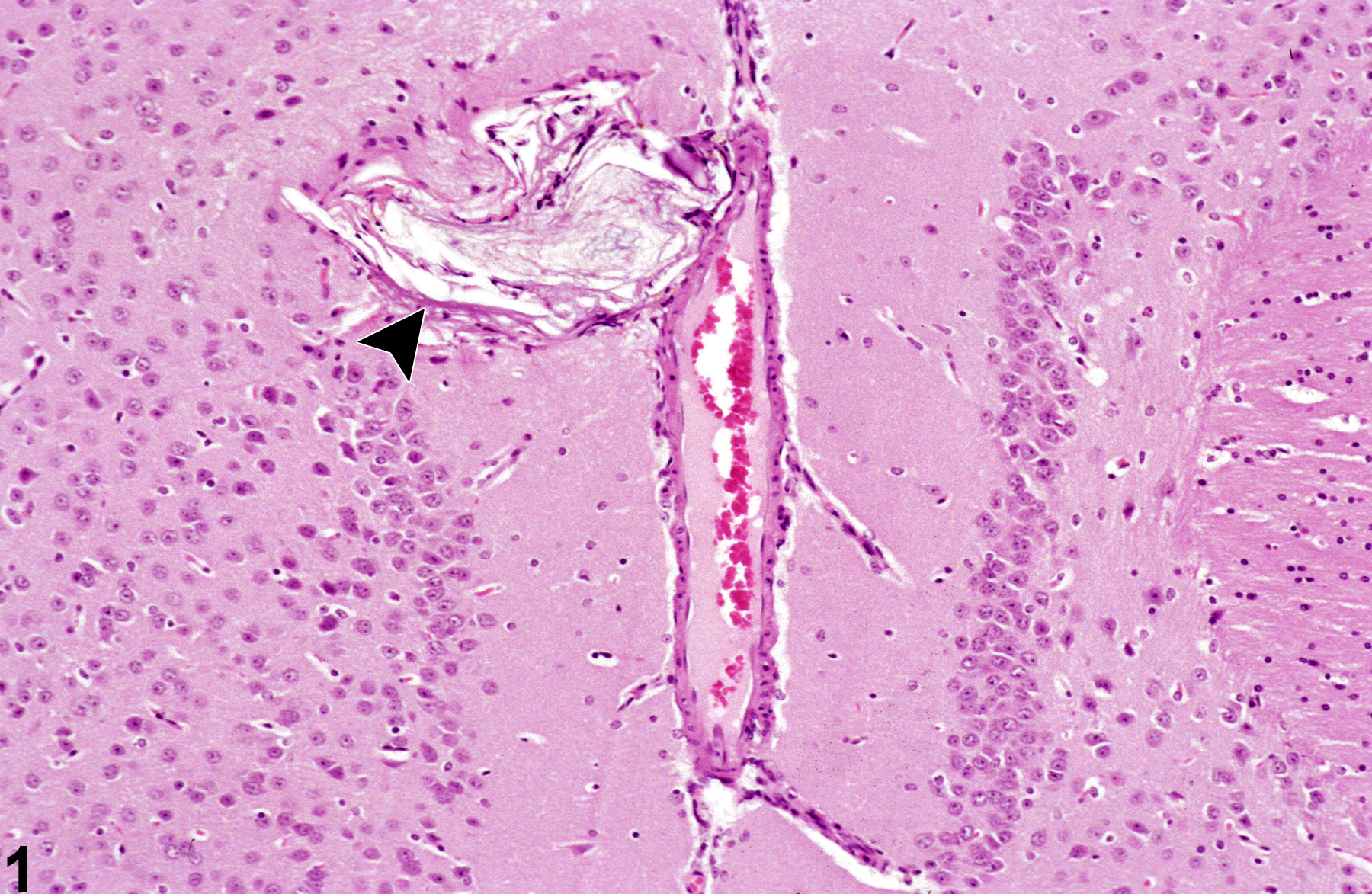 Image of epidermoid cyst in the brain from a male B6C3F1 mouse in a chronic study