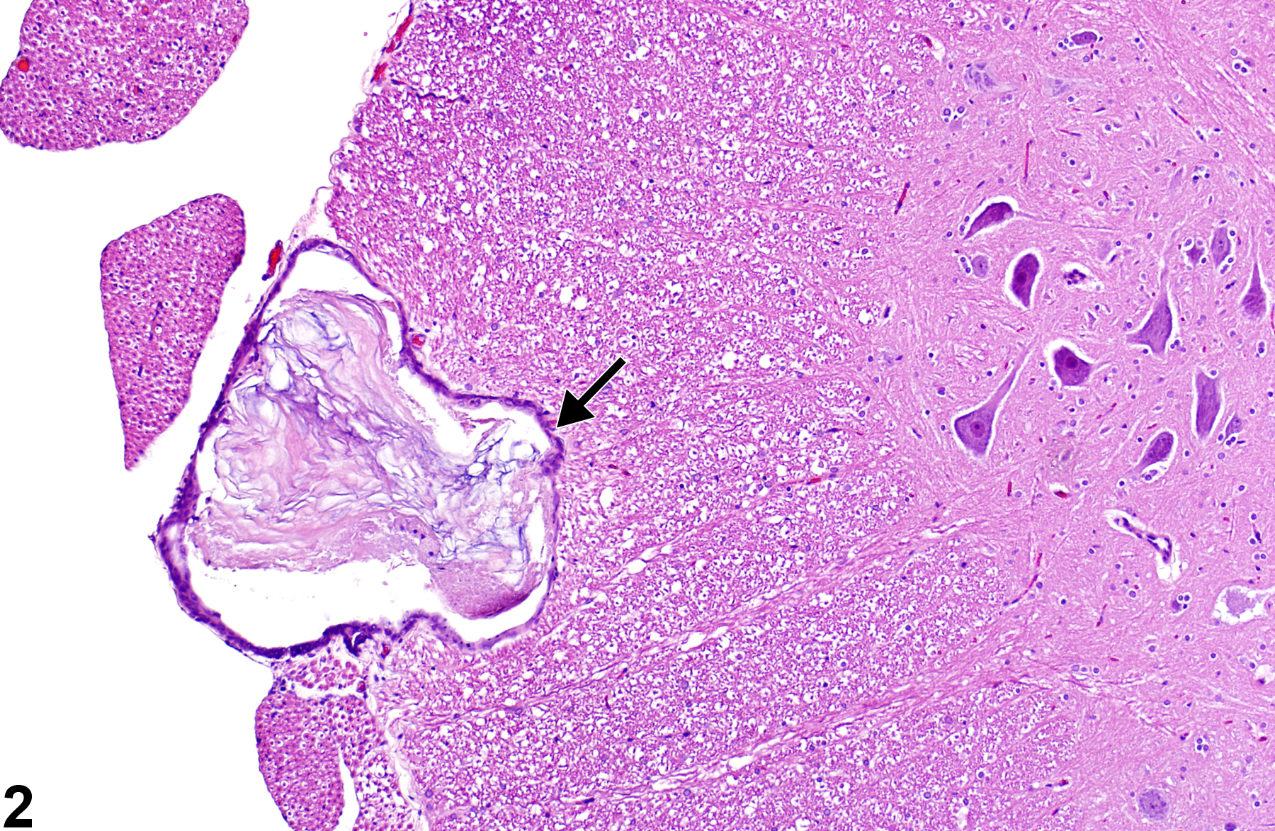 Image of epidermoid cyst in the spinal cord from a male Harlan Sprague-Dawley rat in a chronic study