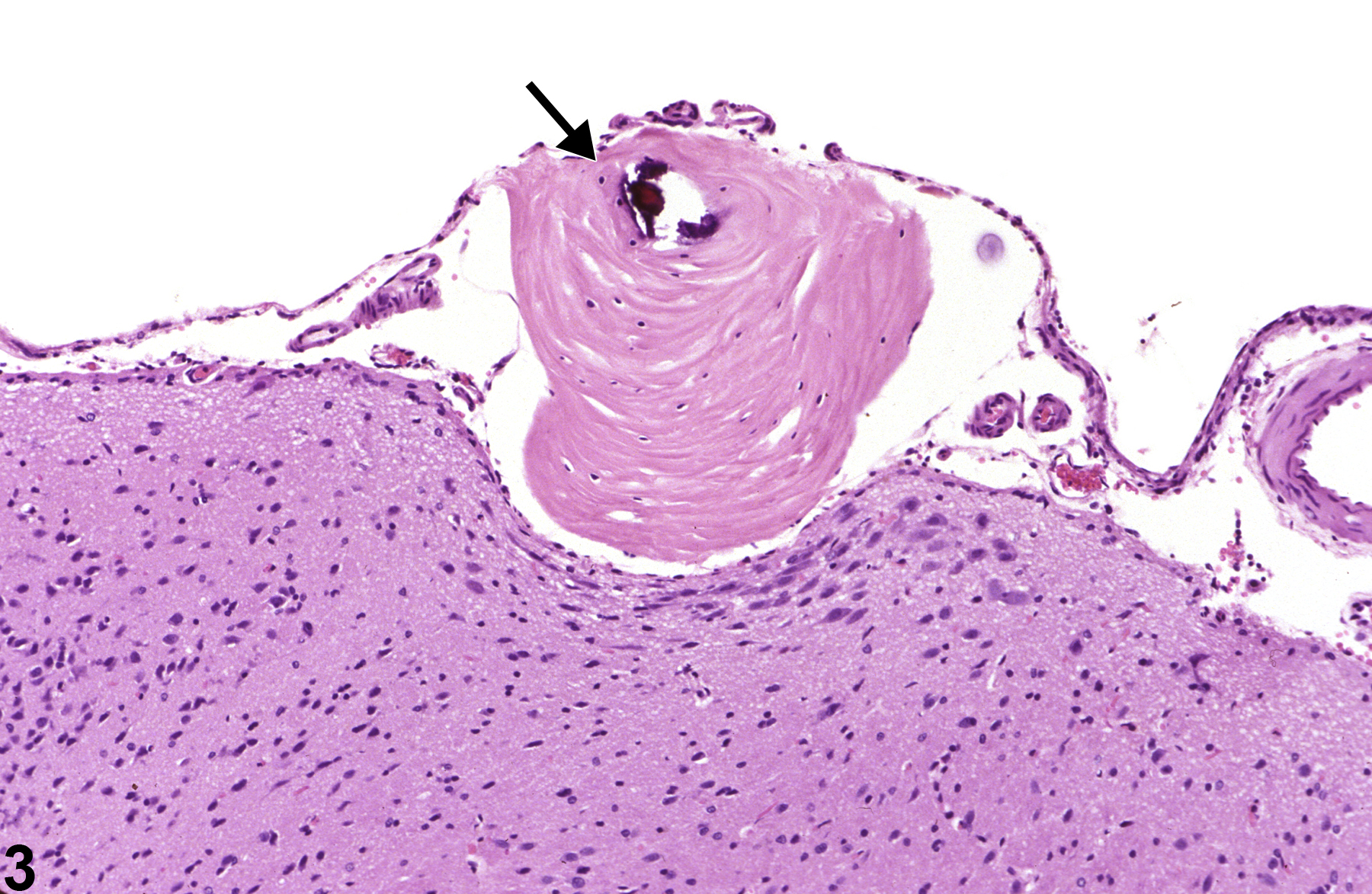 Image of epidermoid cyst in the brain from a male F344/N rat in a chronic study