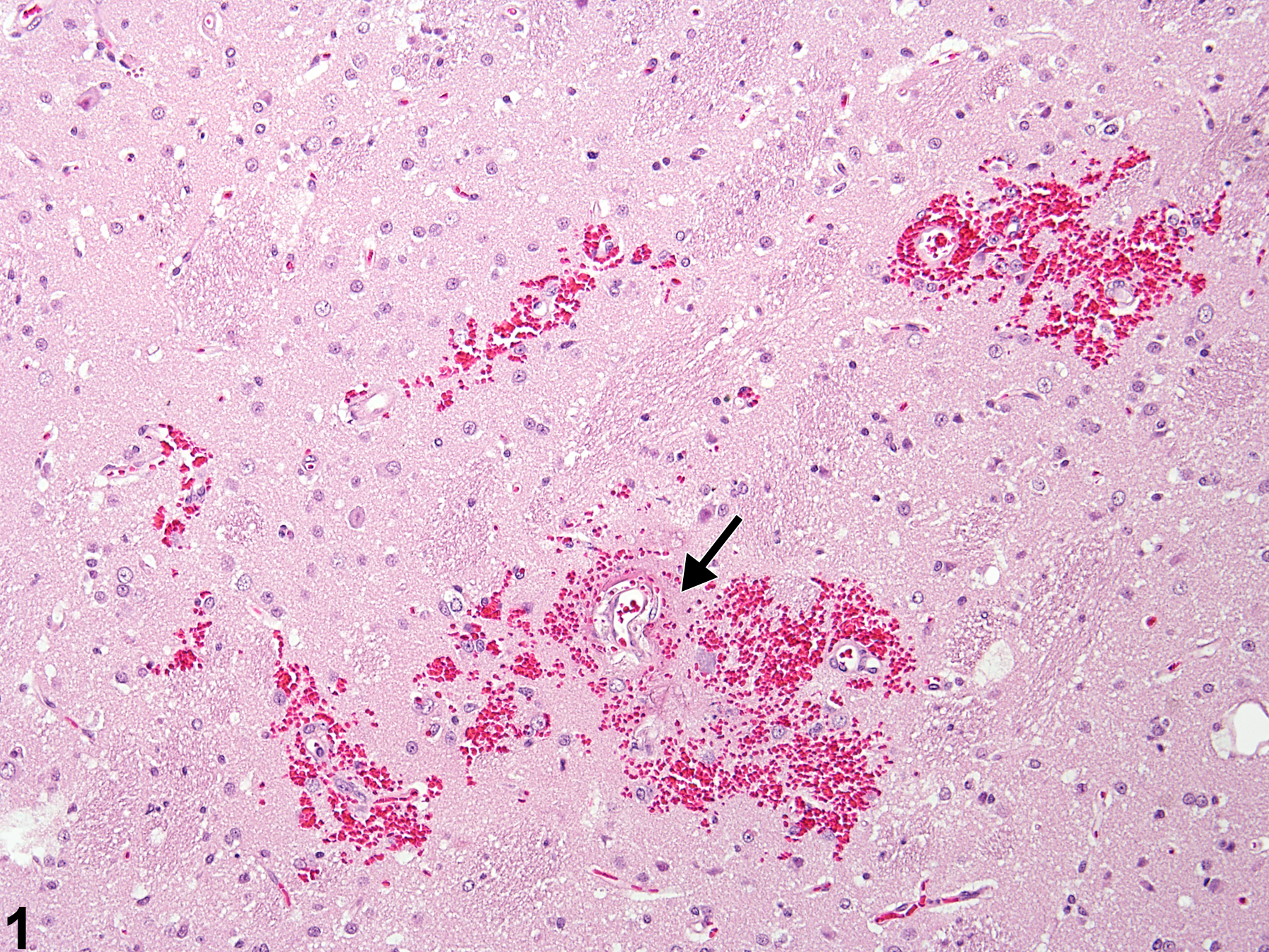 Image of hemorrhage in the brain from a male F344/N rat in a chronic study