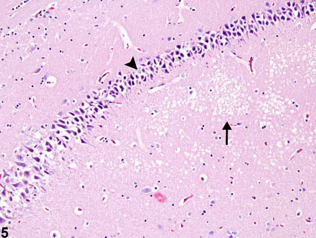 Image of artifactual basophilic neurons and artifactual white matter vacuolation  in the brain from a male F344/N rat in a chronic study