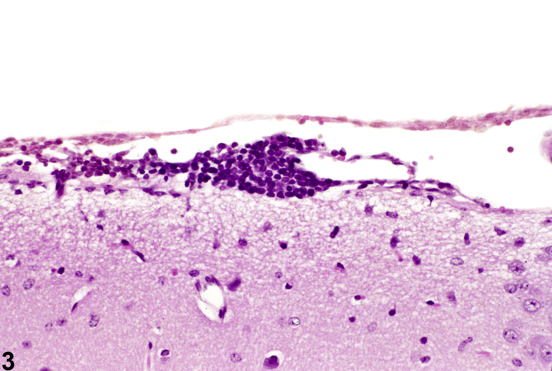 Image of inflammation in the brain, leptomeninges from a female B6C3F1 mouse in a chronic study