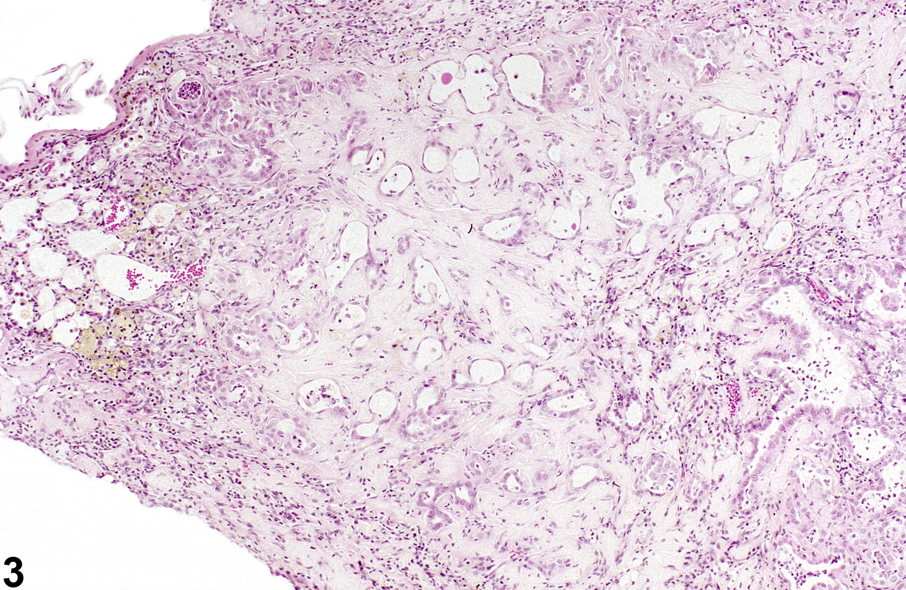 Image of fibrosis in the lung from a male F344/N rat in a chronic study
