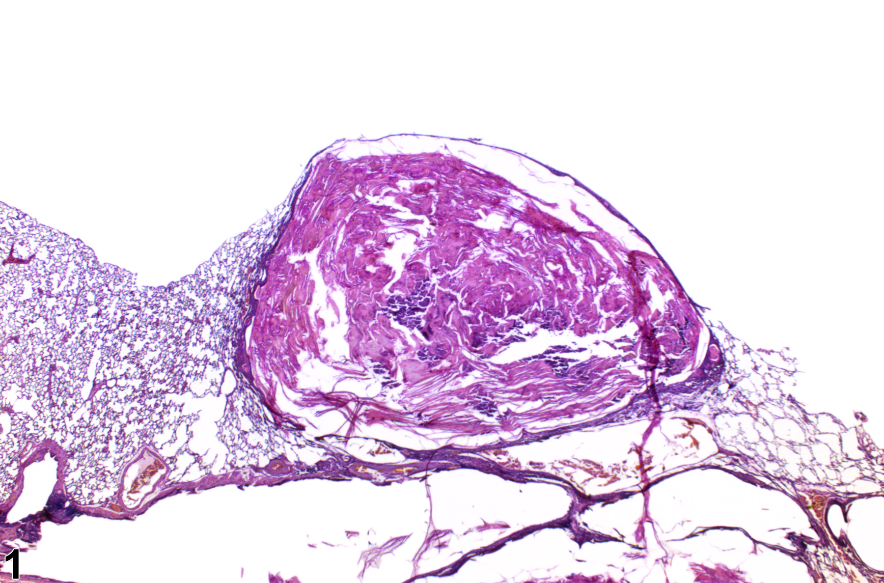 Image of keratinizing cyst in the lung from a male F344/N rat in a chronic study