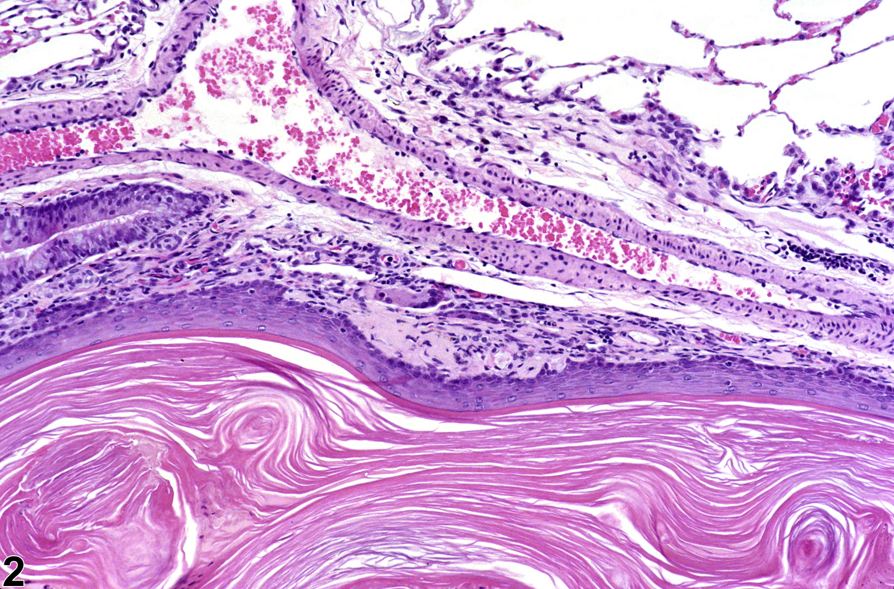 Image of keratinizing cyst in the lung from a male F344/N rat in a chronic study