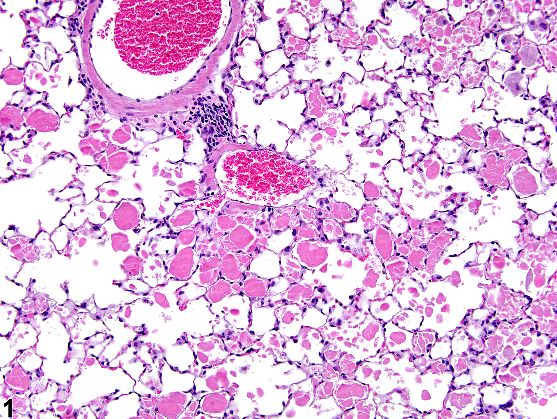 Image of alveolar proteinosis in the lung from a male B6C3F1/N mouse in a chronic study