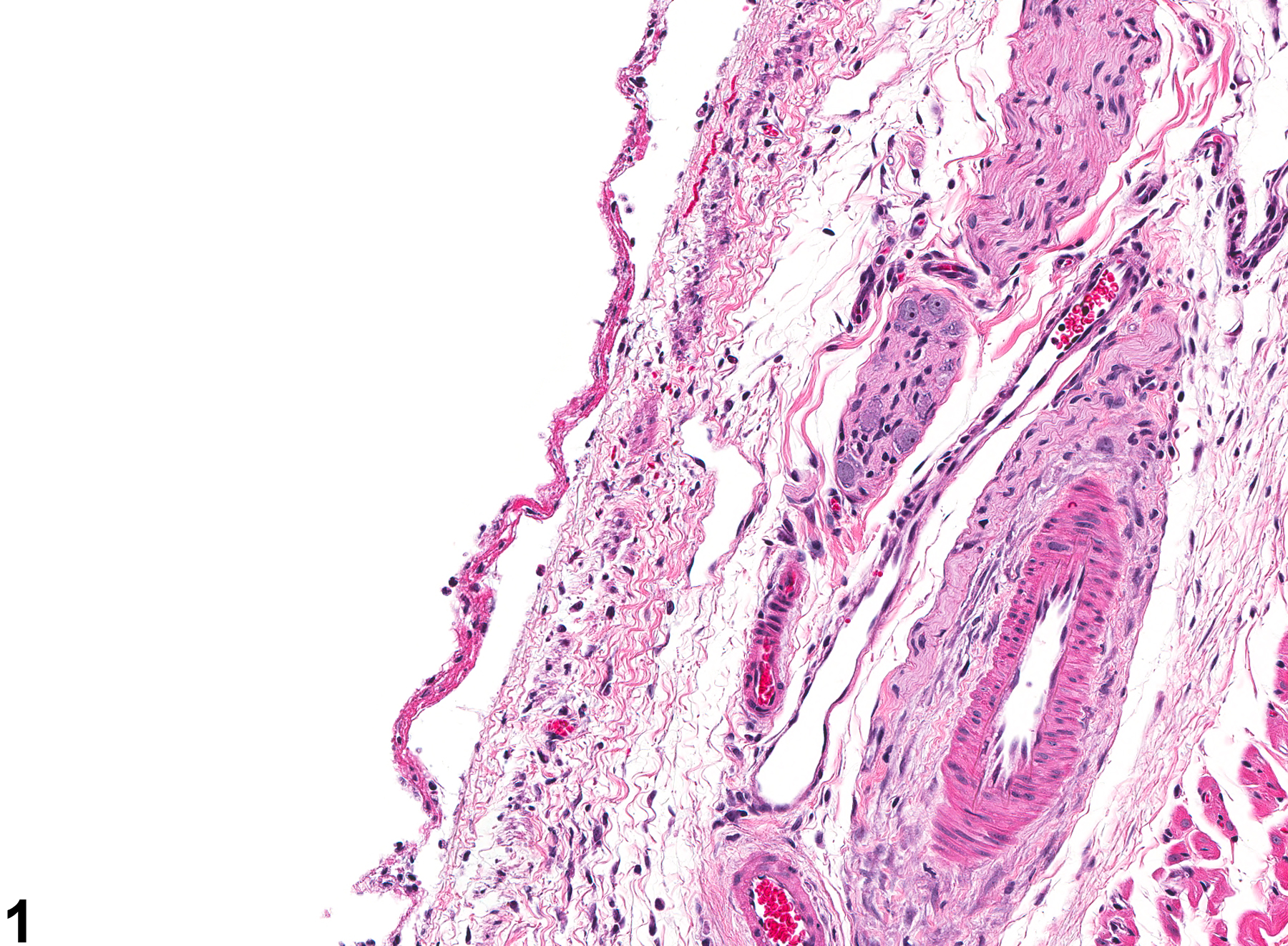 Image of bronchial ulceration in the lung from a male Wistar Han rat in a acute study