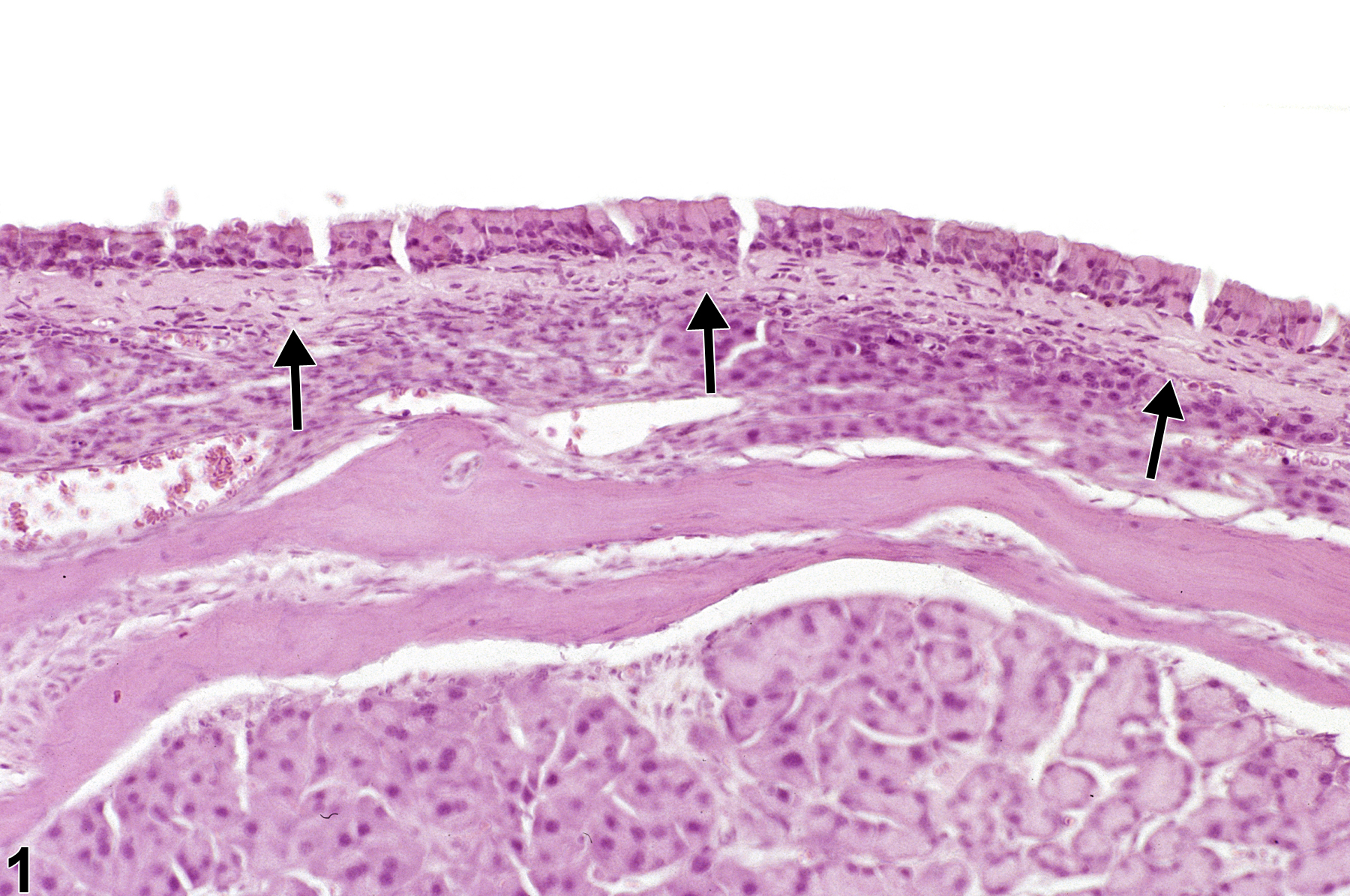 Image of fibrosis in the nose, transitional epithelium from a female B6C3F1/N mouse in a chronic study