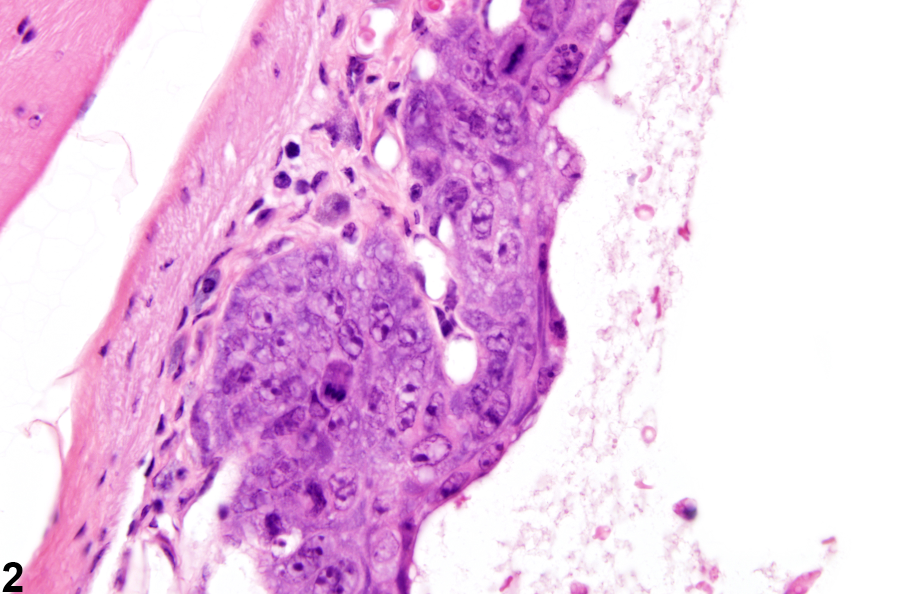 Image of hyperplasia, atypical in the nose, respiratory epithelium from a female B6C3F1/N mouse in a chronic study