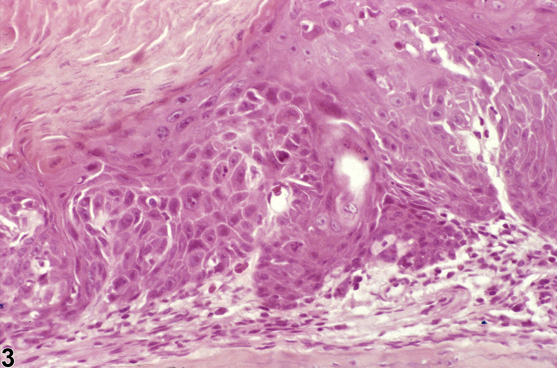 Image of hyperplasia, atypical in the nose, squamous epithelium from a female Osborne Mendel rat in a chronic study