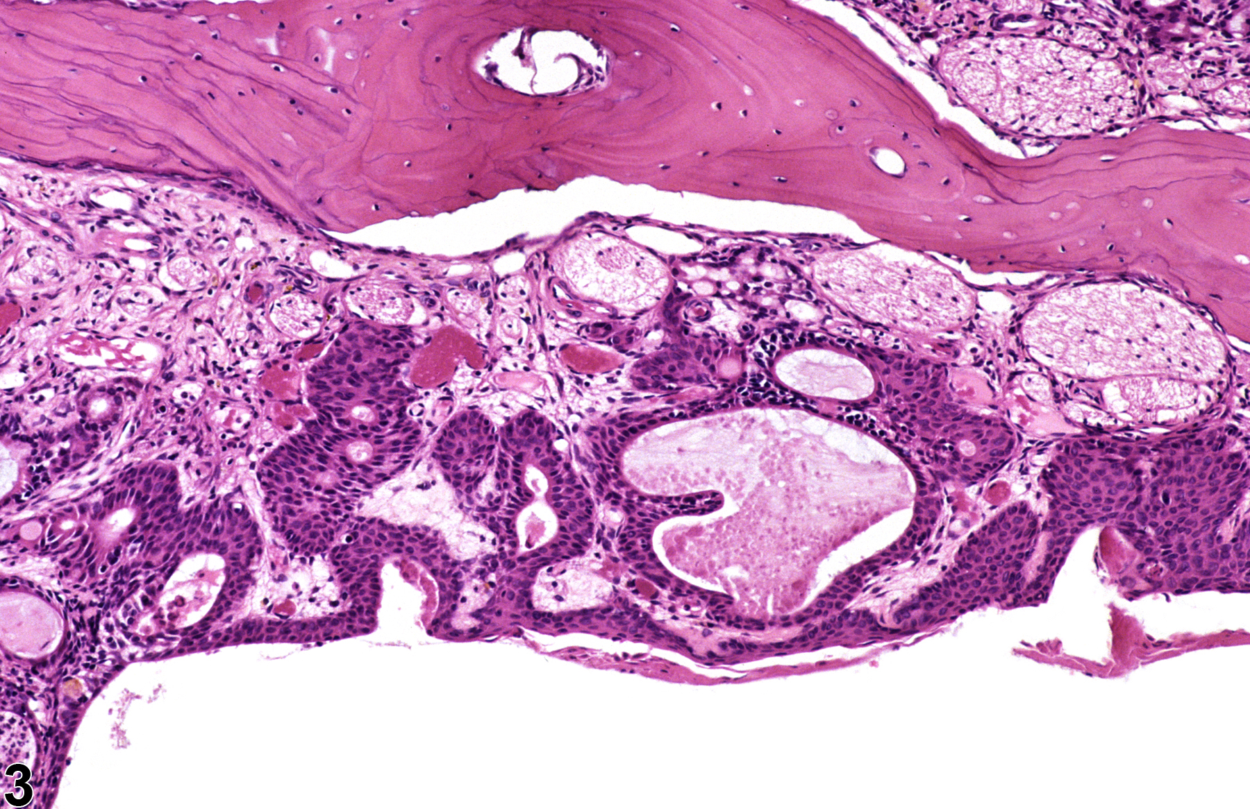 Image of metaplasia, squamous in the nose, olfactory epithelium, glands from a male F344/N rat in a chronic study