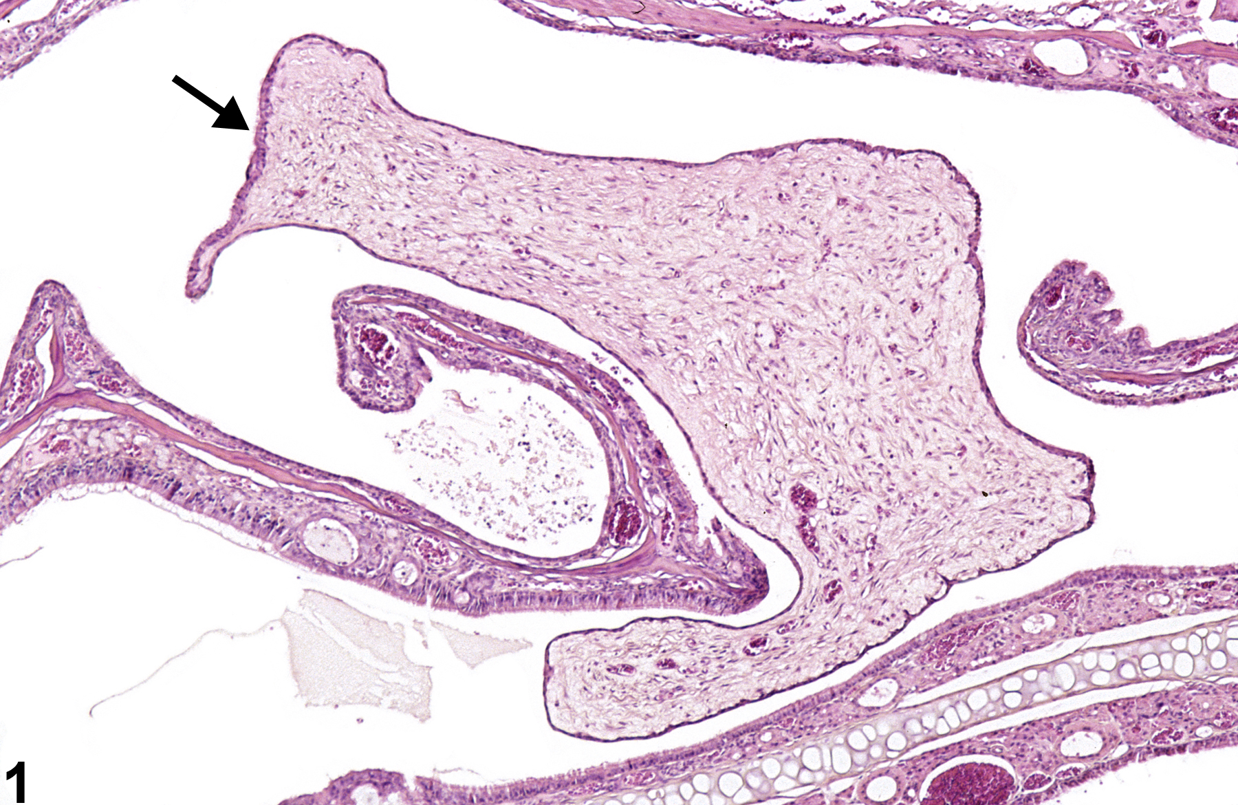 Image of polyp, inflammatory in the nose from a male B6C3F1/N mouse in a chronic study