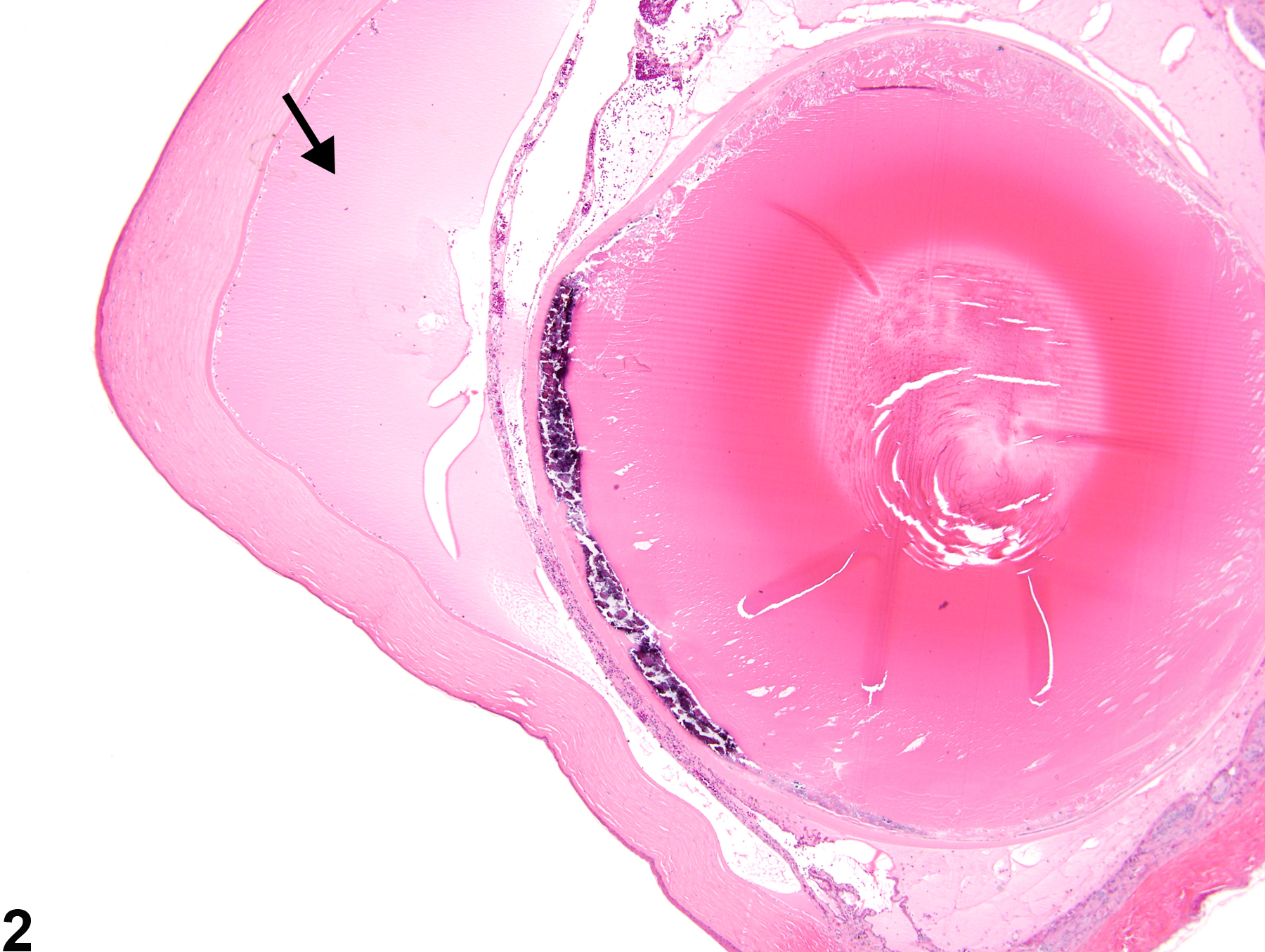 Image of anterior chamber proteinaceous fluid in the eye from a female F344/N rat in a chronic study