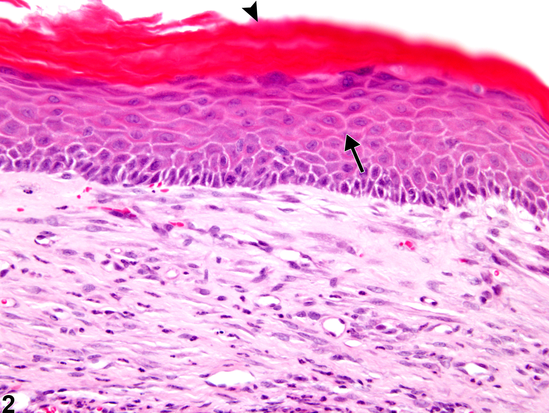 Image of cornea hyperplasia, squamous in the eye from a male B6C3F1 mouse in a chronic study