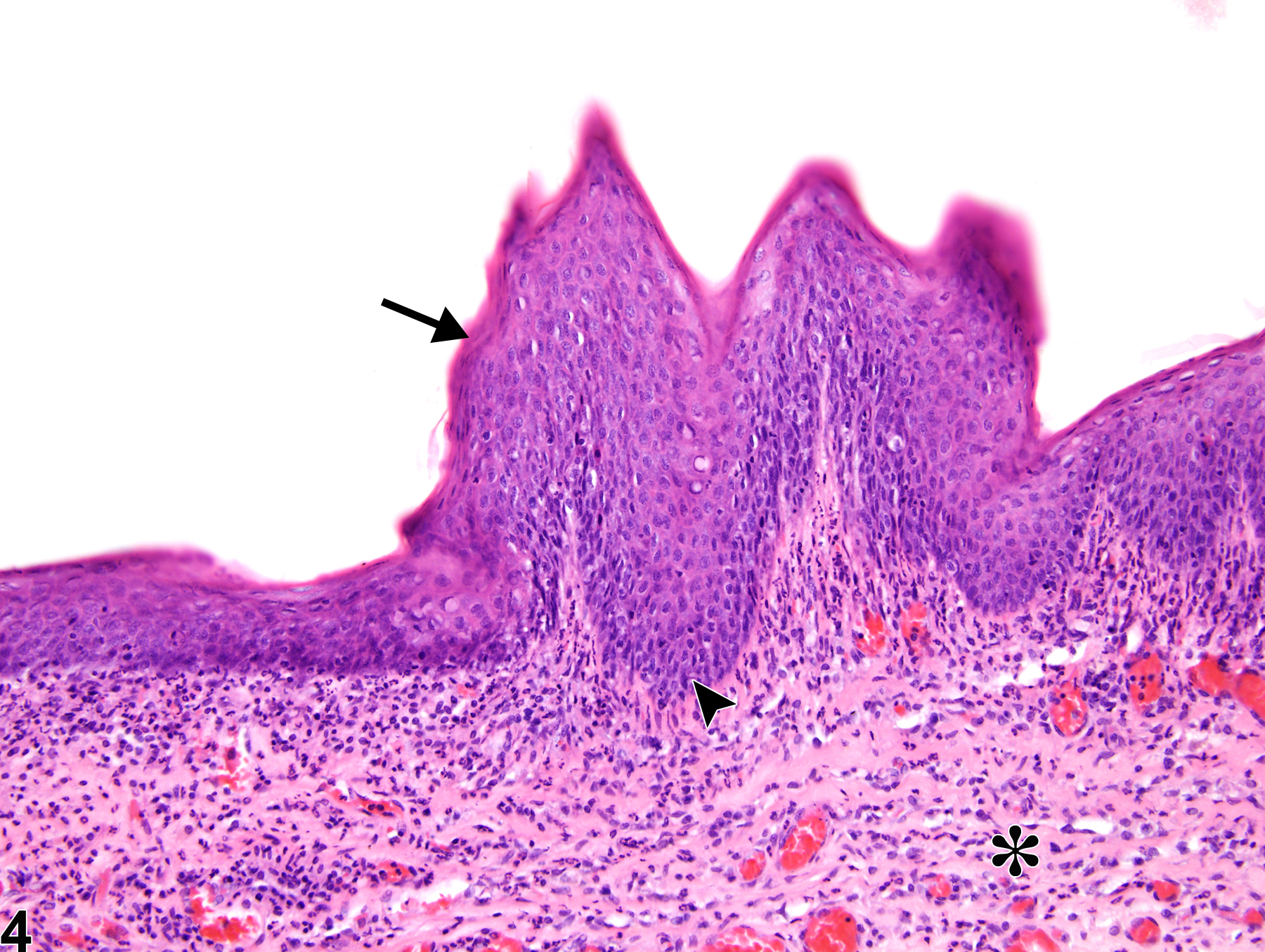 Image of cornea hyperplasia, squamous in the eye from a male F344/N rat in a chronic study