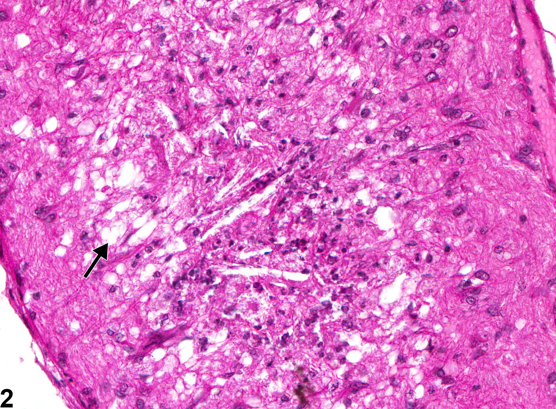 Image of optic nerve degeneration in the eye from a female B6C3F1 mouse in a chronic study