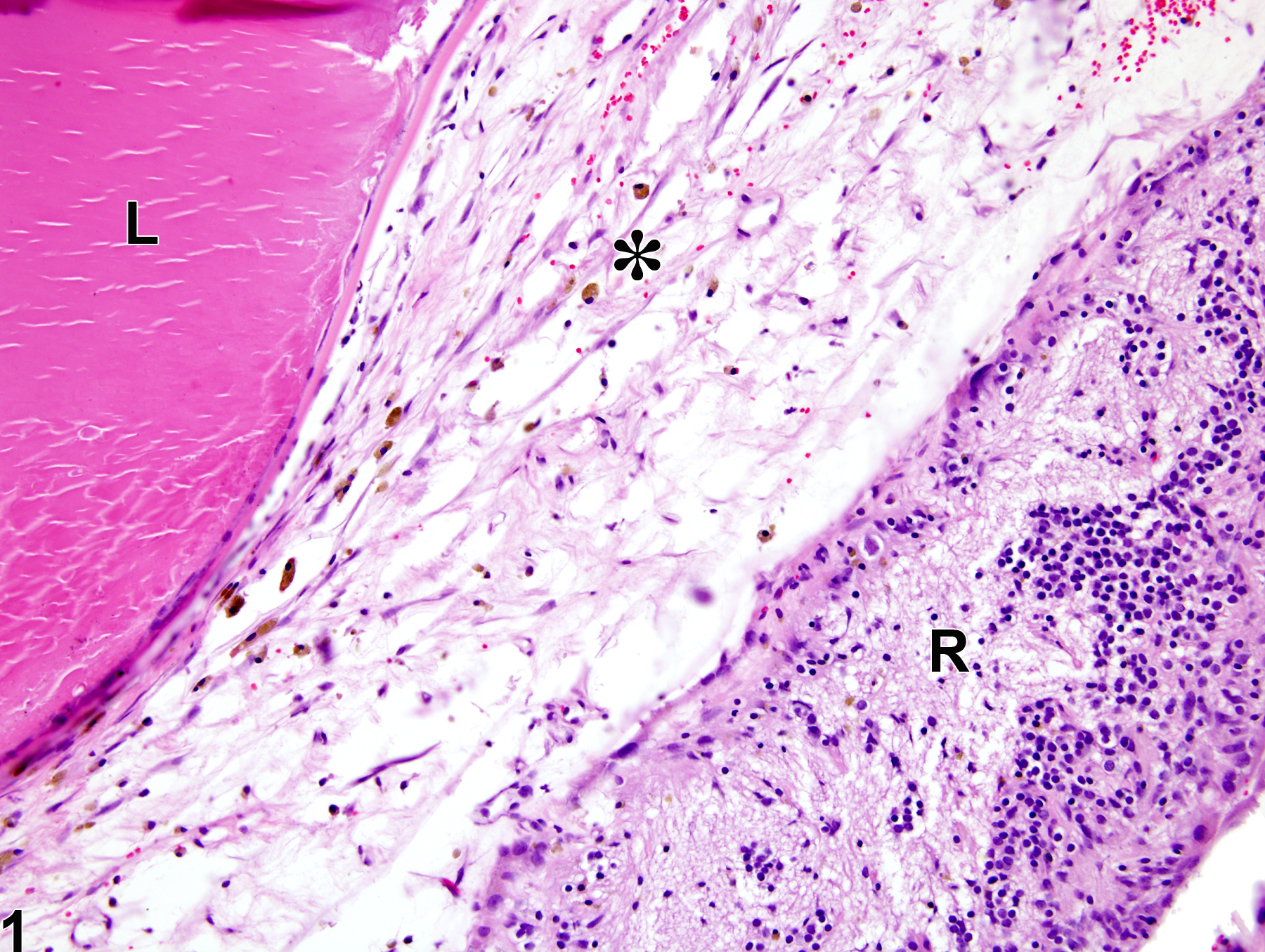 Image of vitreous fibrosis in the eye from a male F344/N rat in a chronic study