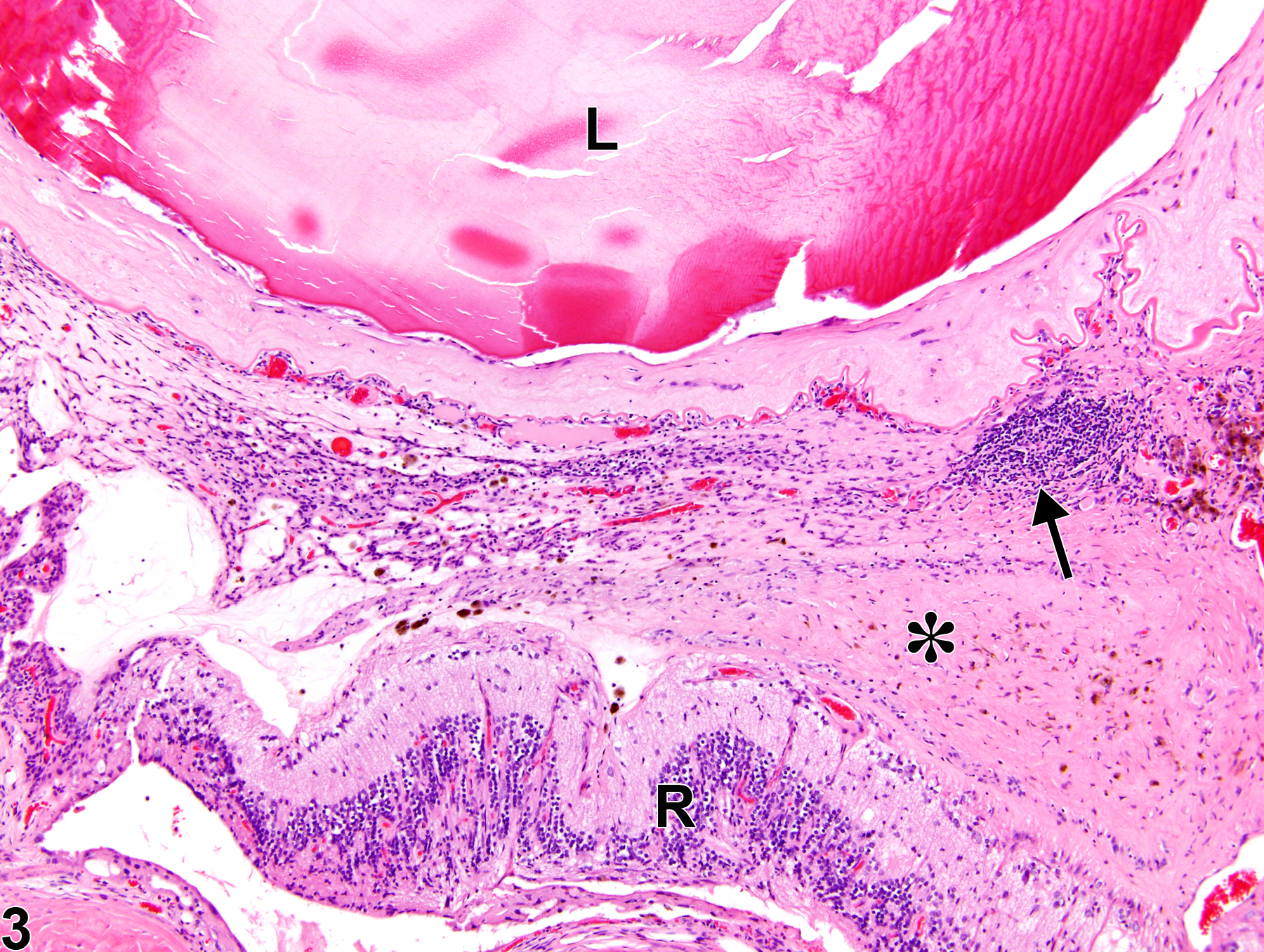 Image of vitreous fibrosis in the eye from a female F344/N rat in a chronic study