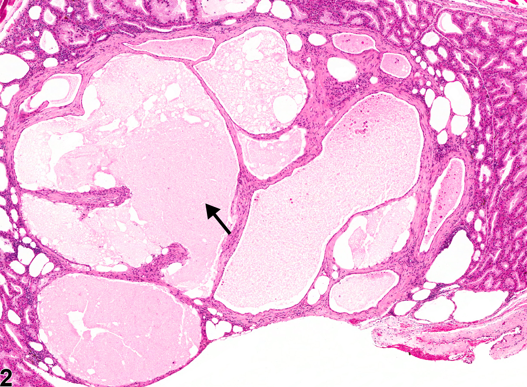 Image of cyst in the Harderian gland from a male B6C3F1 mouse in a chronic study