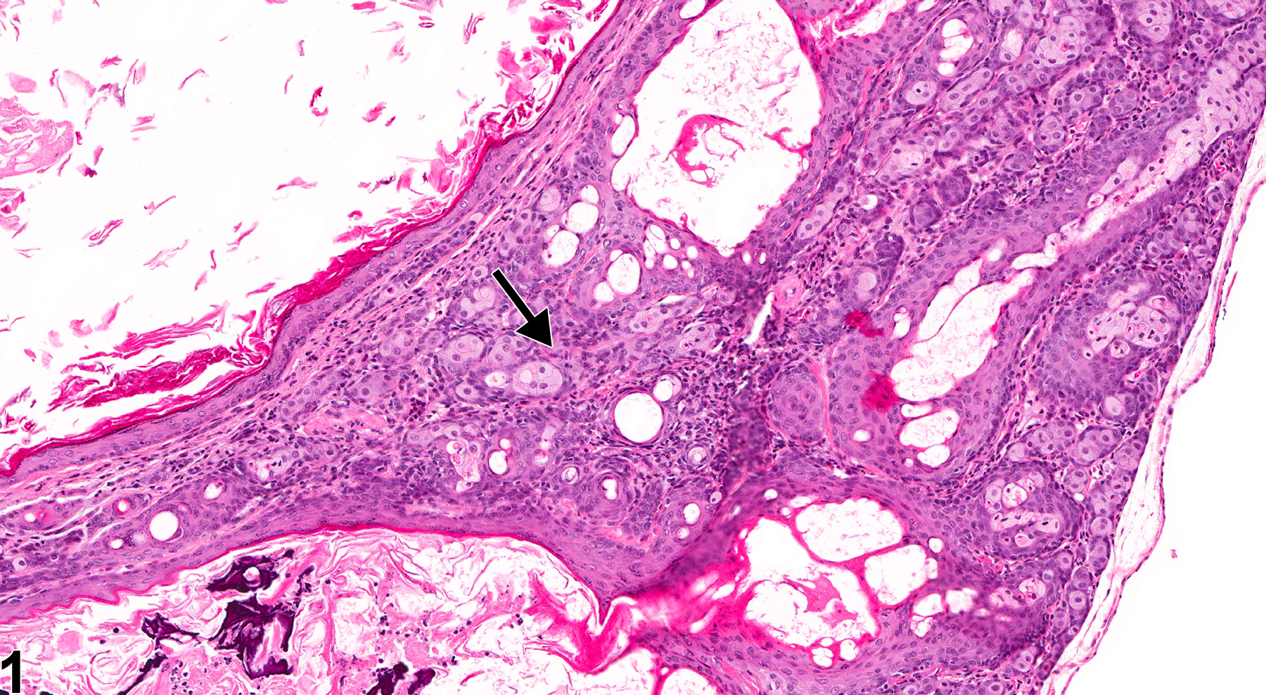 Image of inflammation in the Zymbal's gland from a male Tg.Ac (FVB/N) homozygous mouse in a subchronic study