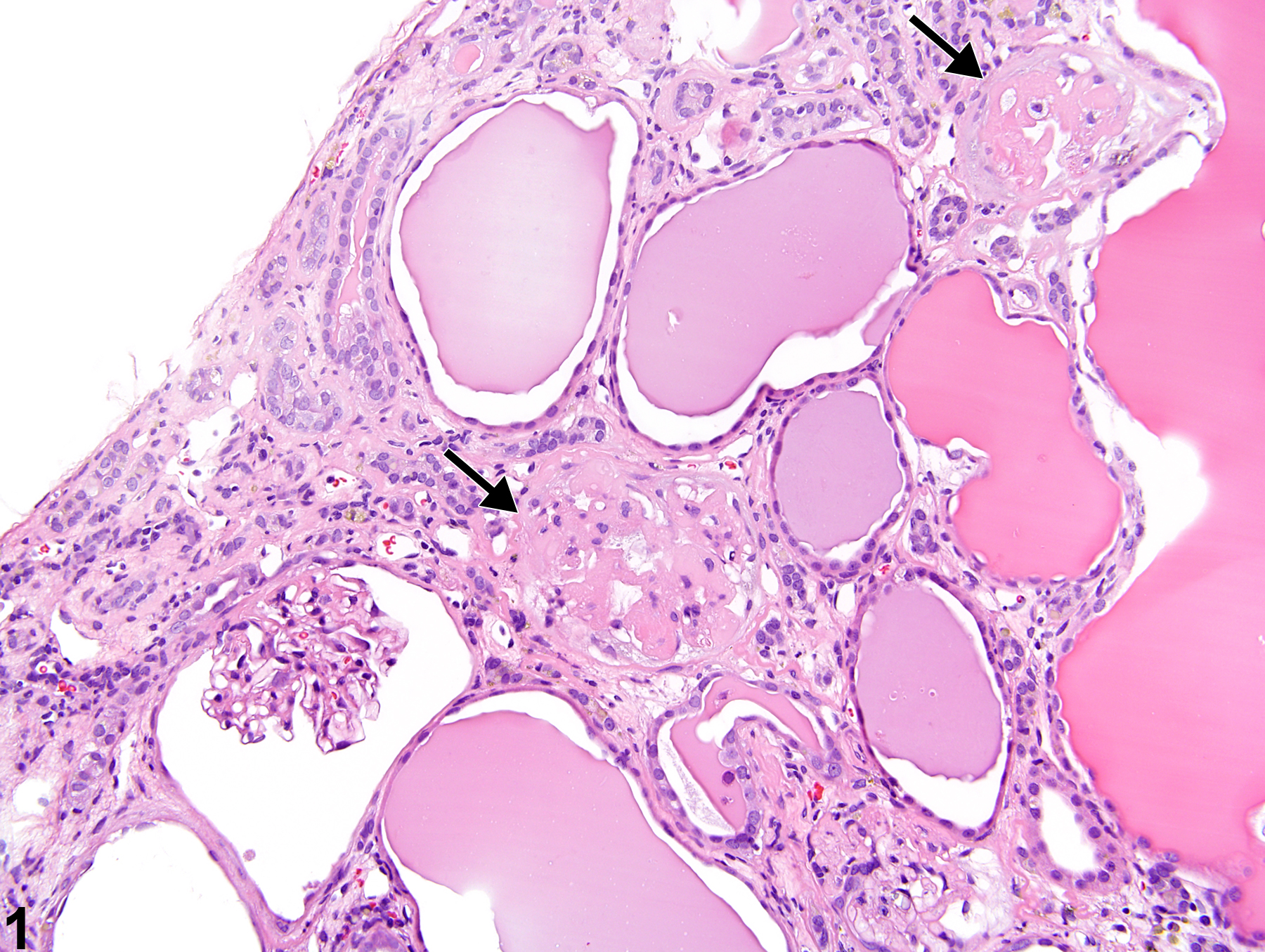 Image of glomerulosclerosis in the kidney from a male Wistar Han rat in a chronic study