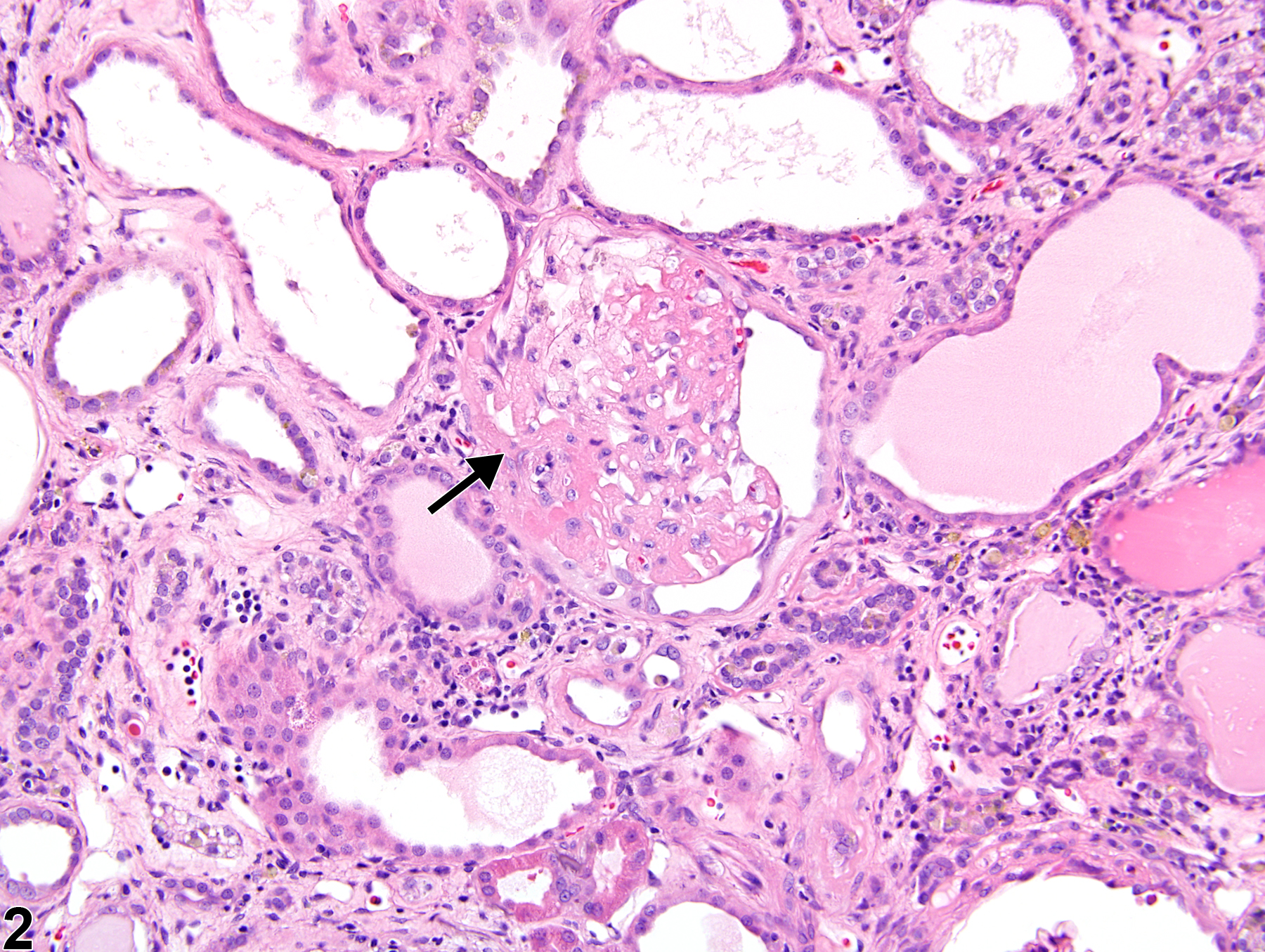 Image of glomerulosclerosis in the kidney from a male Wistar Han rat in a chronic study
