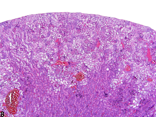 Image of diffuse tubule autolysis mimicking necrosis in the kidney