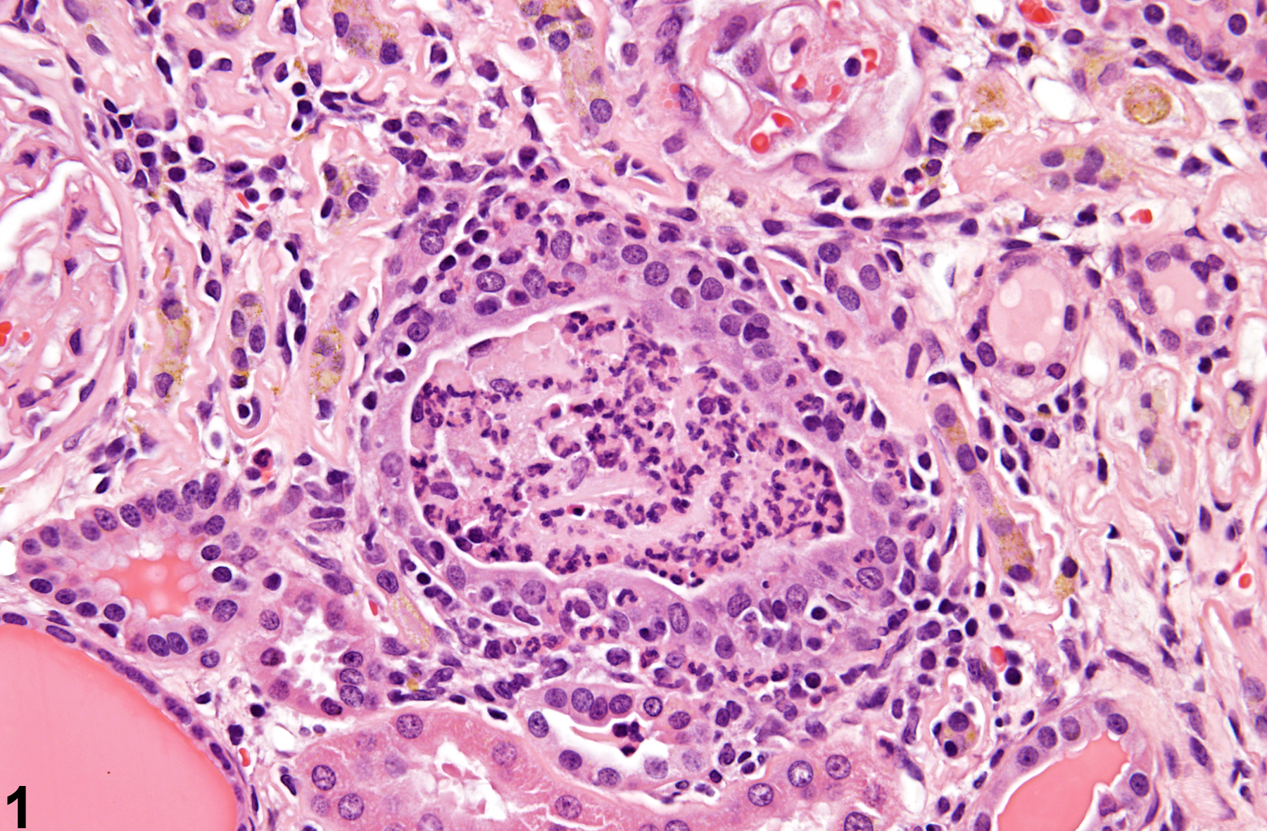 Image of inflammation, acute in the kidney from a male F344/N rat in a chronic study
