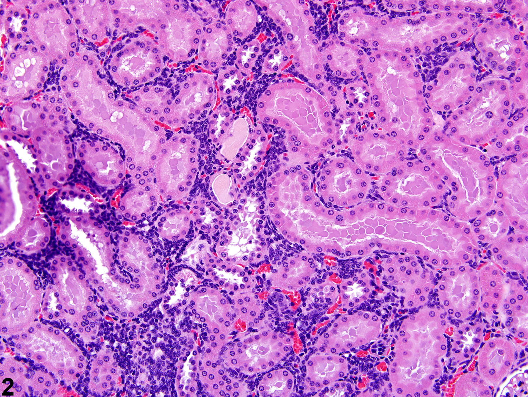 Image of nephroblastematosis in the kidney from a female Harlan Sprague-Dawley rat in a subchronic study