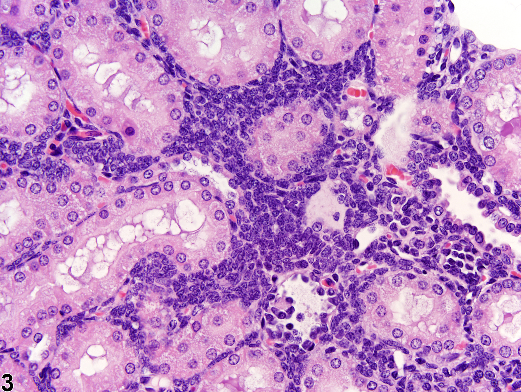 Image of nephroblastematosis in the kidney from a female Harlan Sprague-Dawley rat in a subchronic study