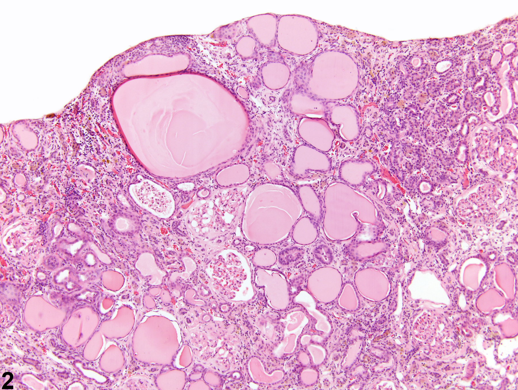 Image of nephropathy, chronic progressive in the kidney from a male F344/N rat in a chronic study