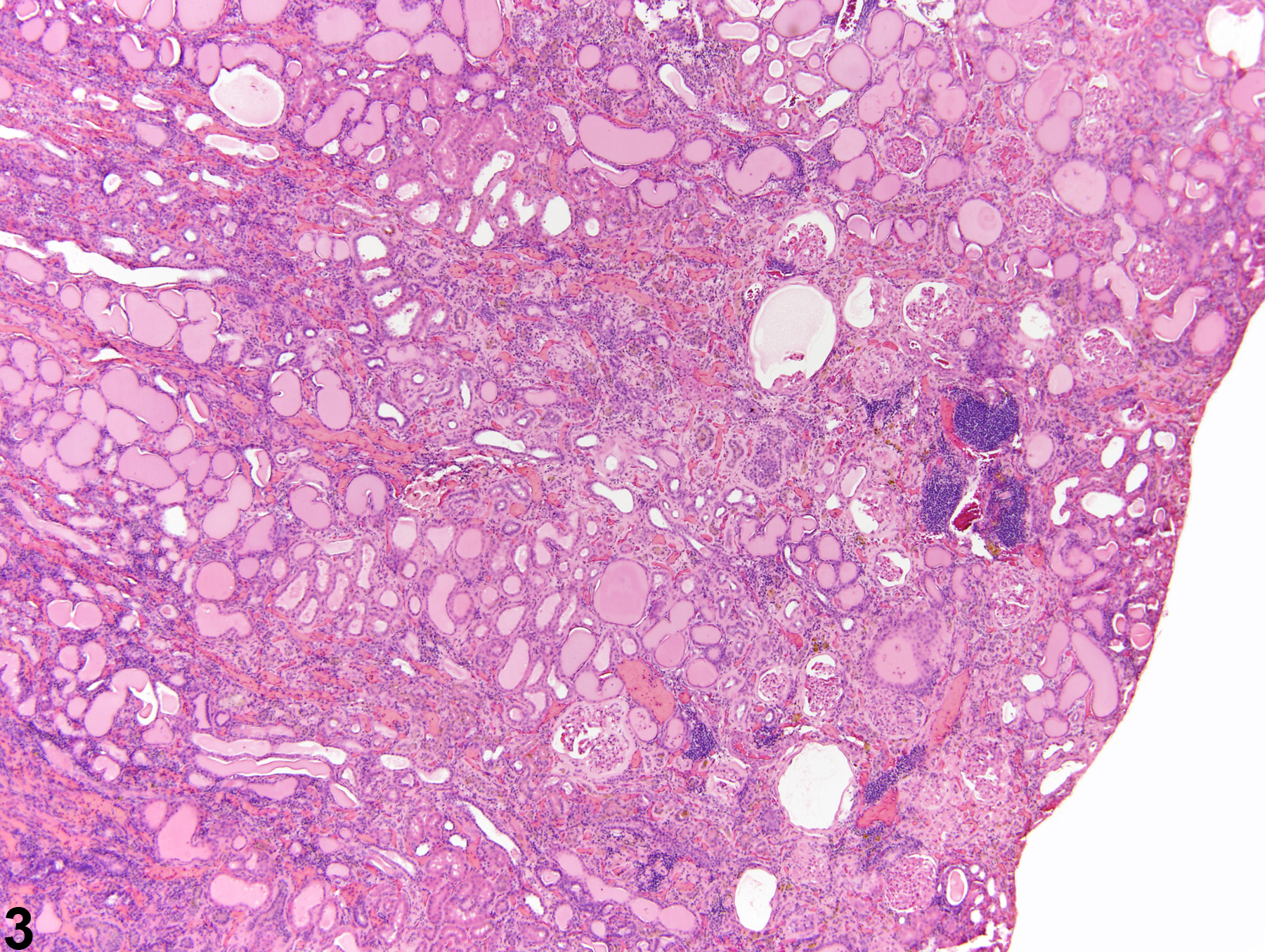 Image of nephropathy, chronic progressive in the kidney from a male F344/N rat in a chronic study