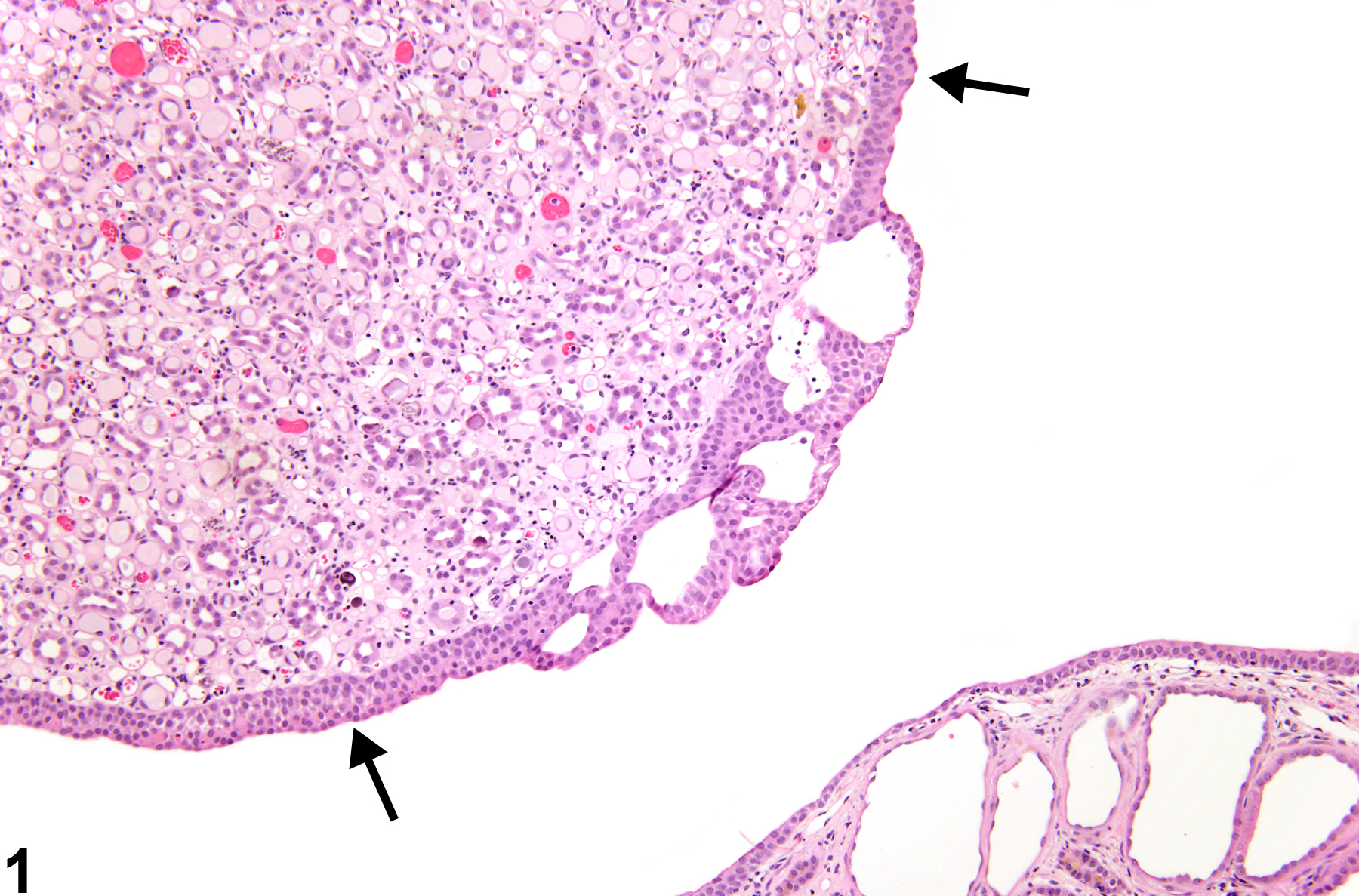 Image of papilla epithelium hyperplasia in the kidney from a male F344/N rat in a chronic study