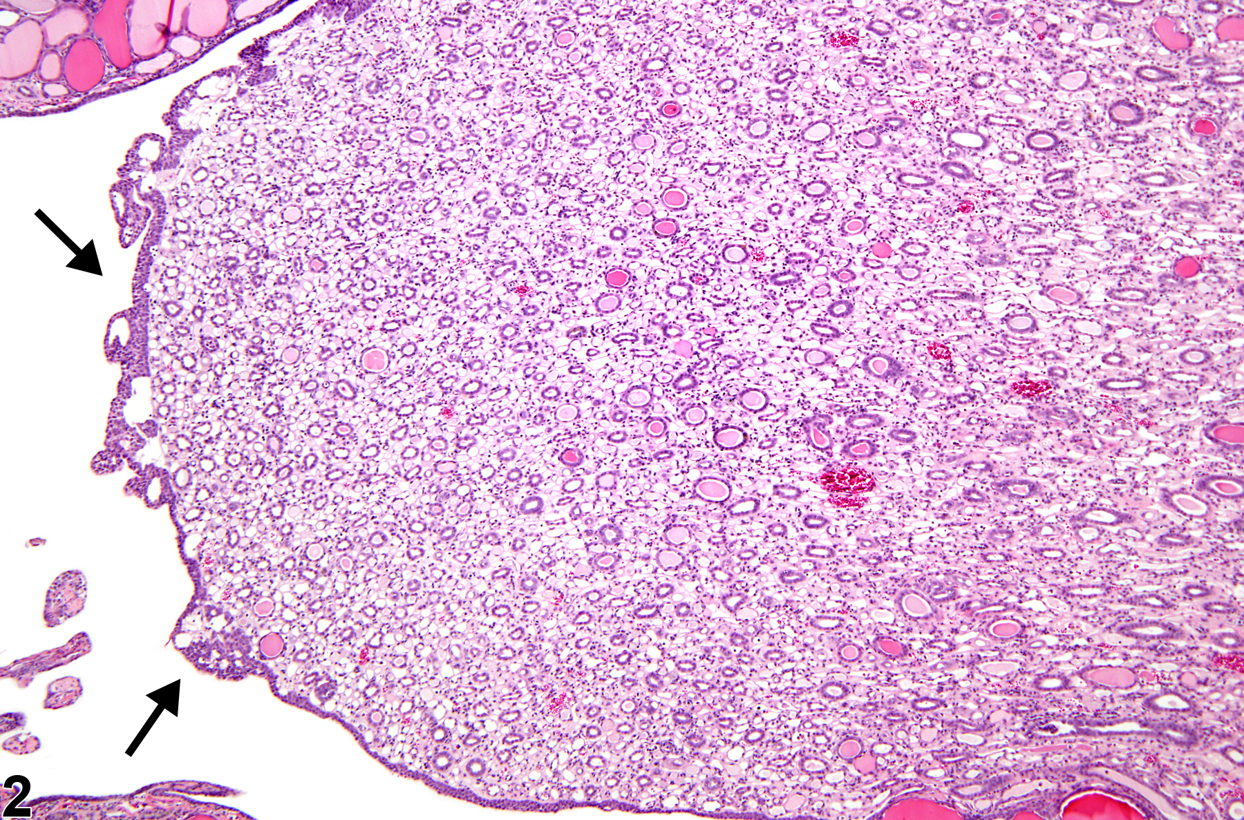 Image of papilla epithelium hyperplasia in the kidney from a male F344/N rat in a chronic study