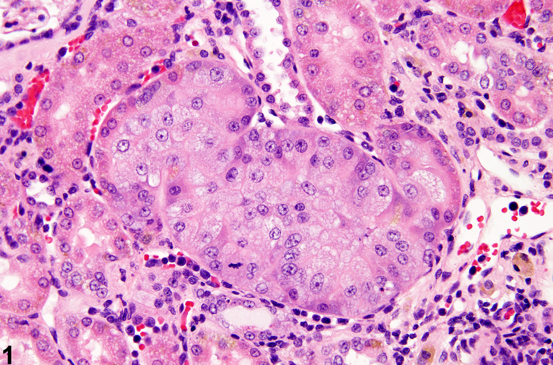Image of renal tubule epithelium atypical tubule hyperplasia in the kidney from a male F344/N rat in a chronic study