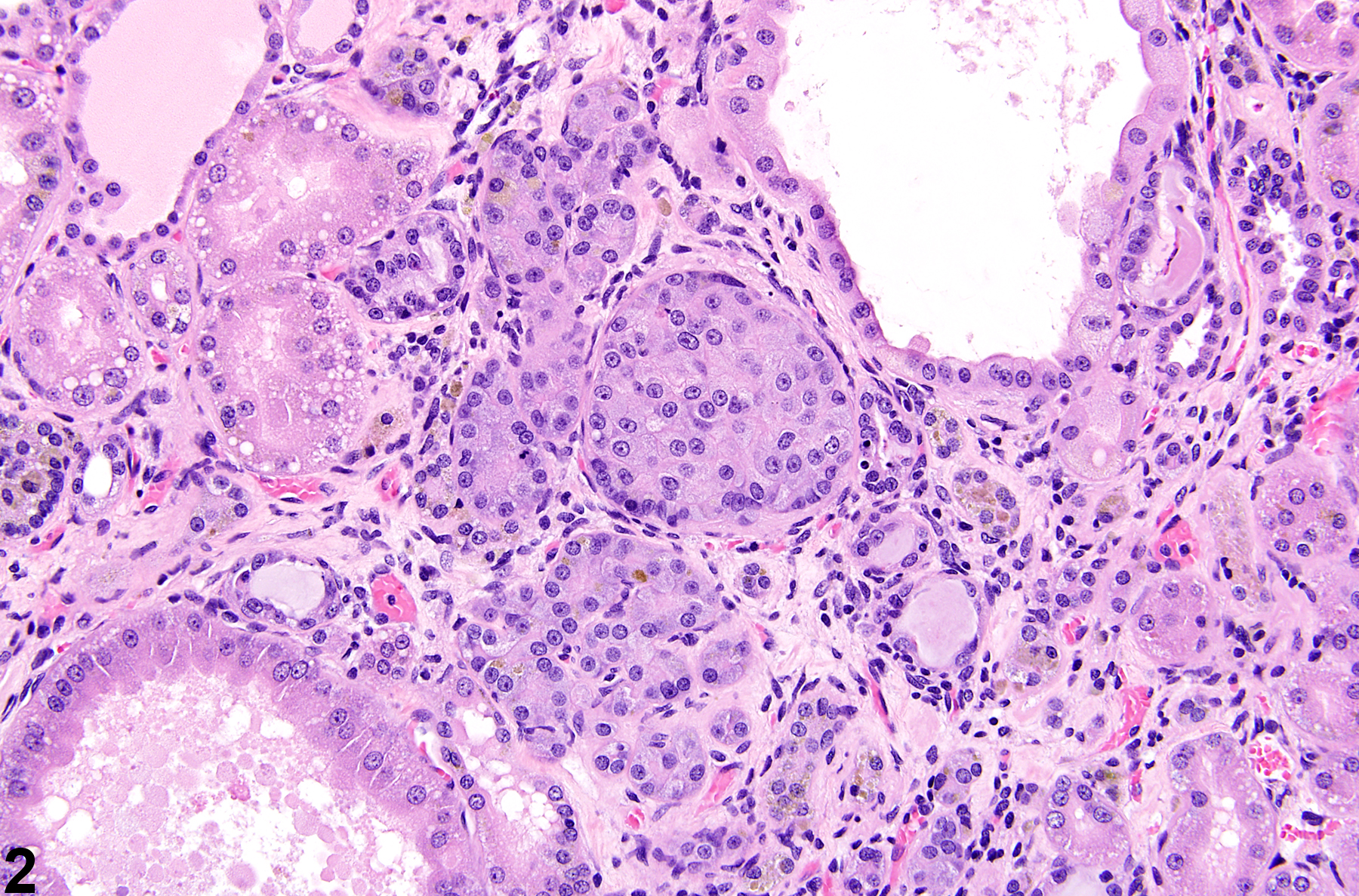 Image of renal tubule epithelium atypical tubule hyperplasia in the kidney from a male F344/N rat in a chronic study