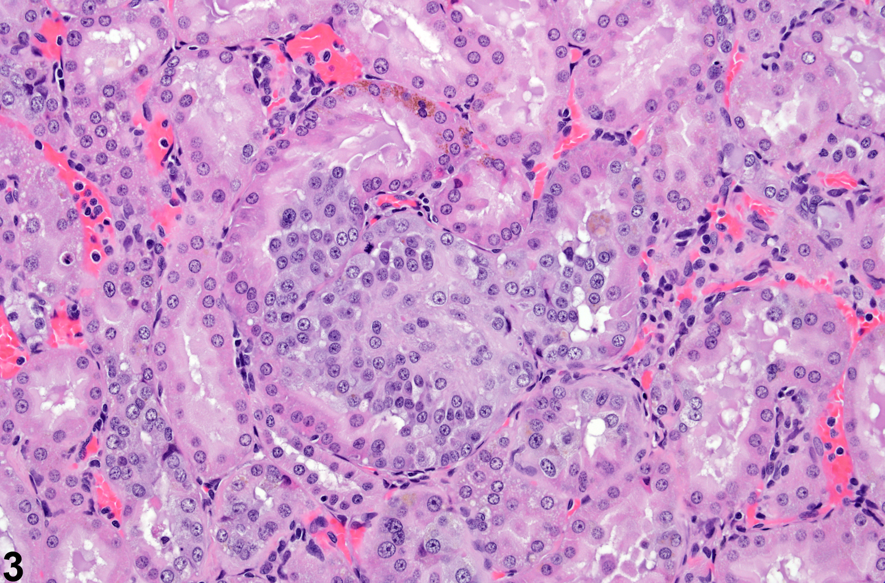 Image of renal tubule epithelium atypical tubule hyperplasia in the kidney from a female F344/N rat in a chronic study