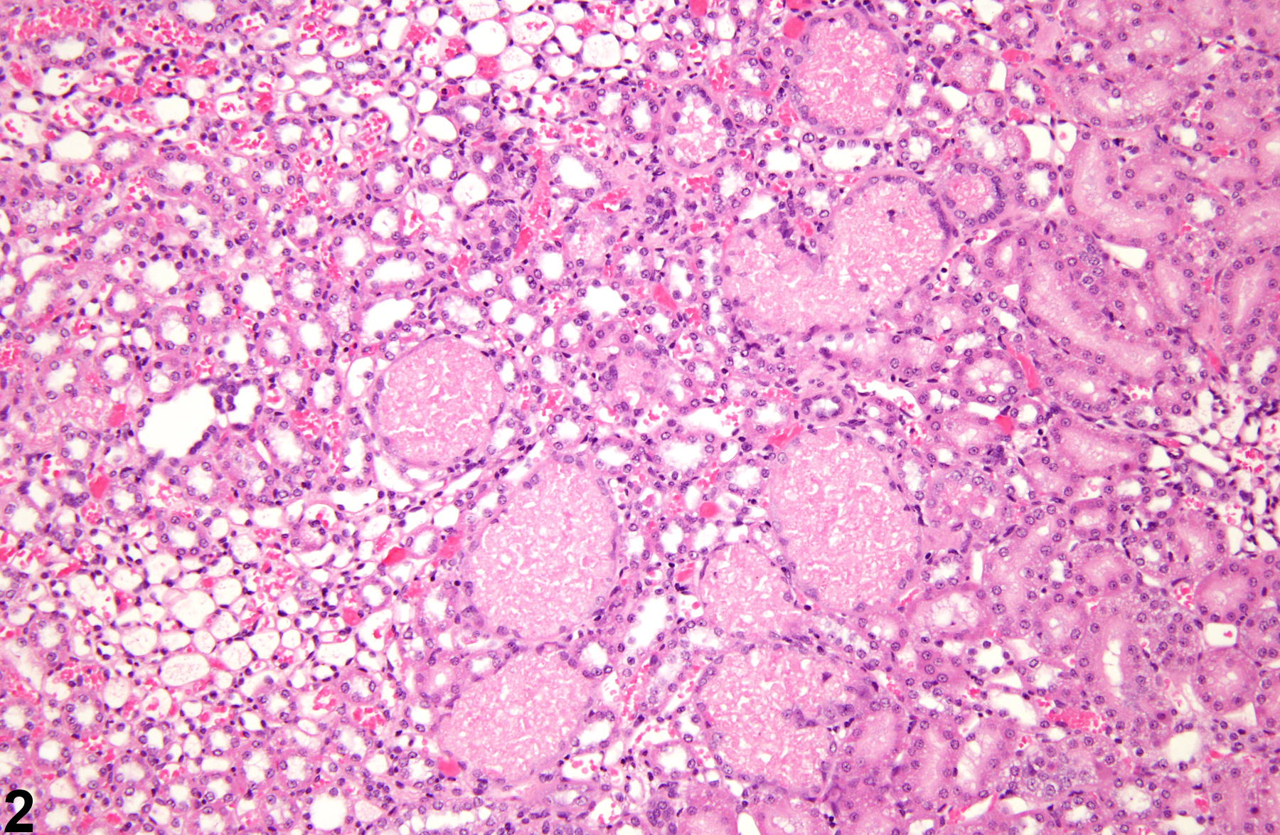 Image of renal tubule cast in the kidney from a male F344/N rat in a subchronic study